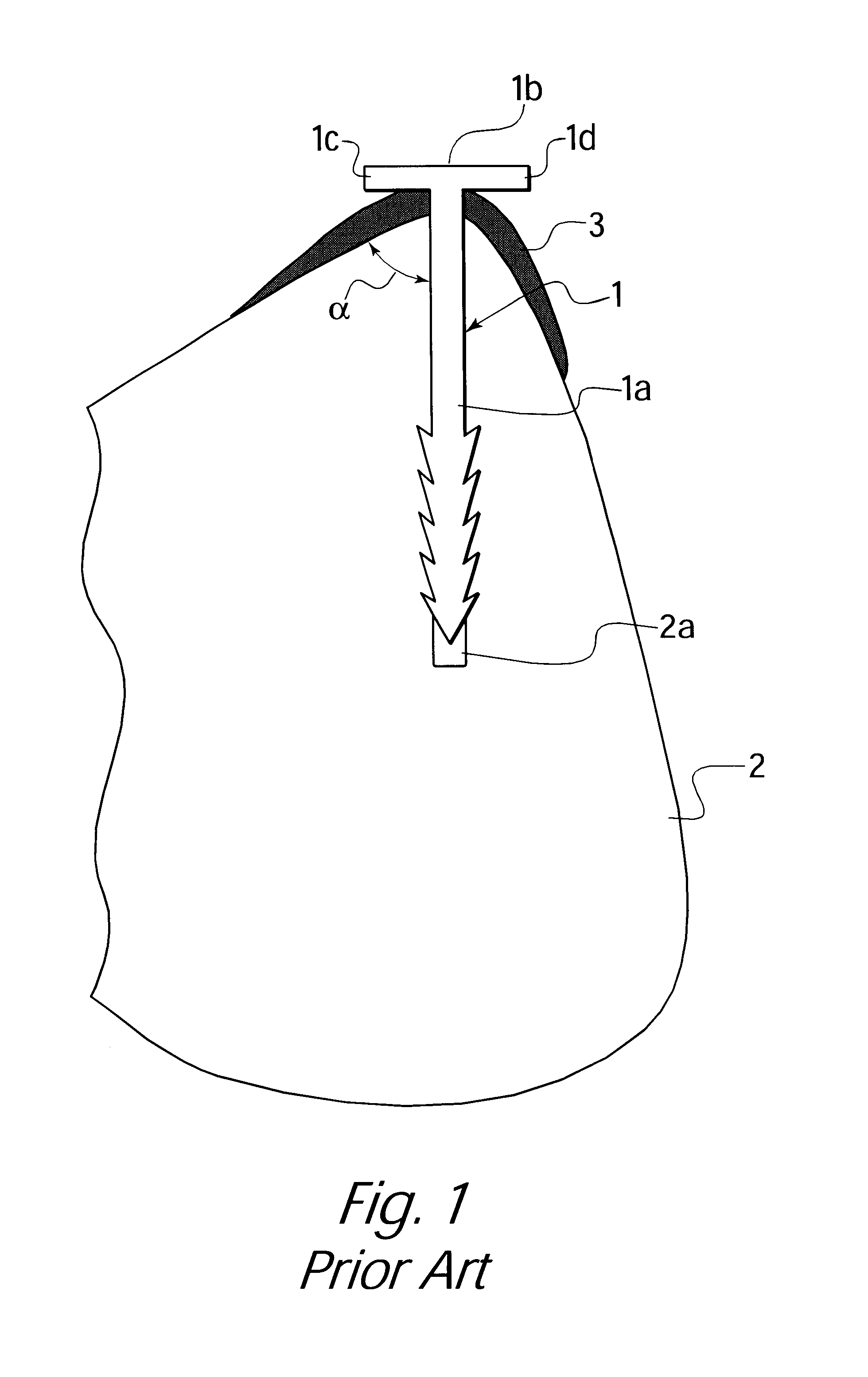 Anatomical fixation implant