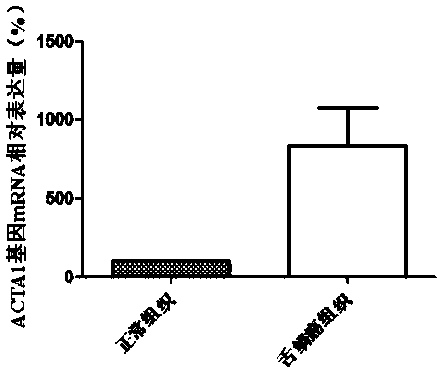 Use of acta1 as a marker for the diagnosis and treatment of tongue squamous cell carcinoma