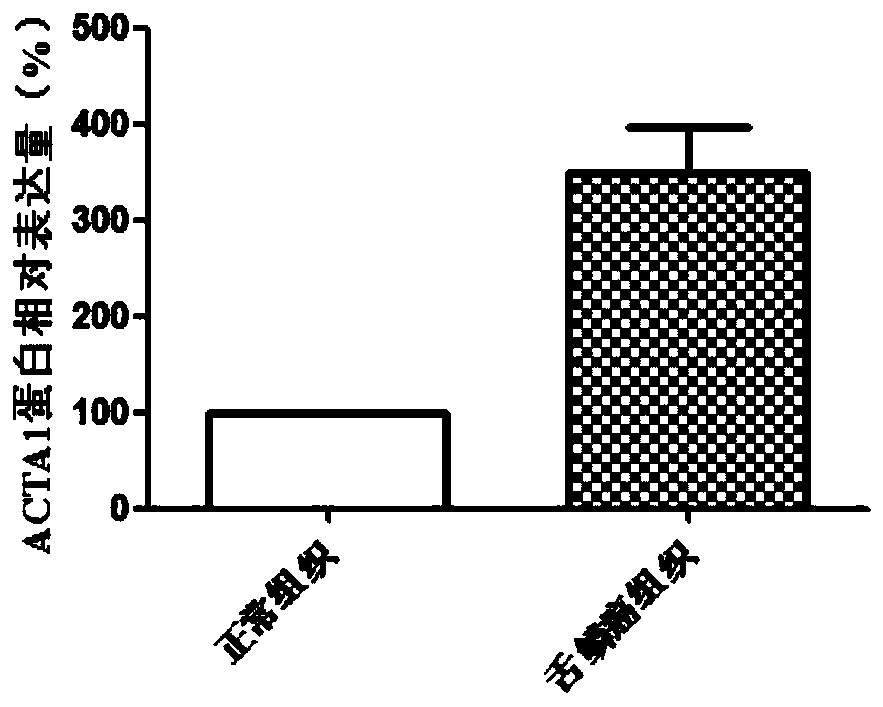 Use of acta1 as a marker for the diagnosis and treatment of tongue squamous cell carcinoma