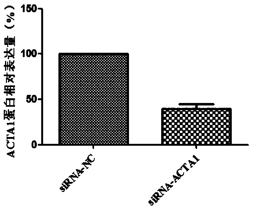 Use of acta1 as a marker for the diagnosis and treatment of tongue squamous cell carcinoma