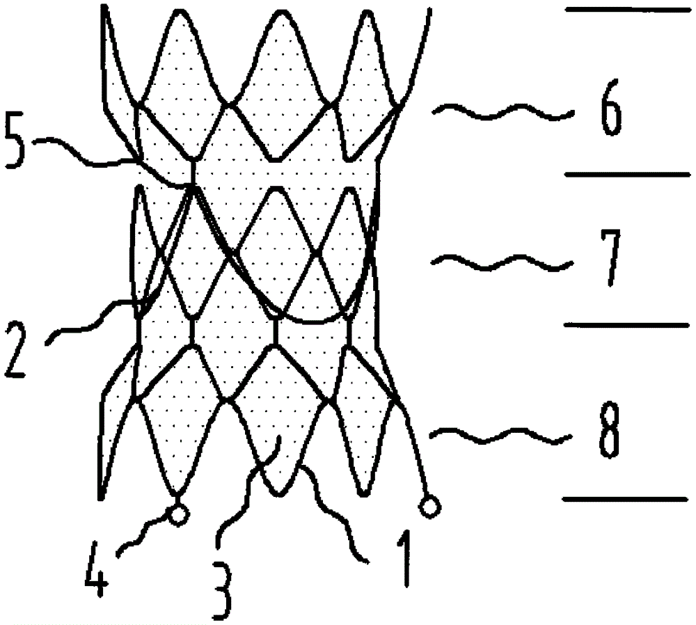 An interventional replacement valve and its controllable delivery device