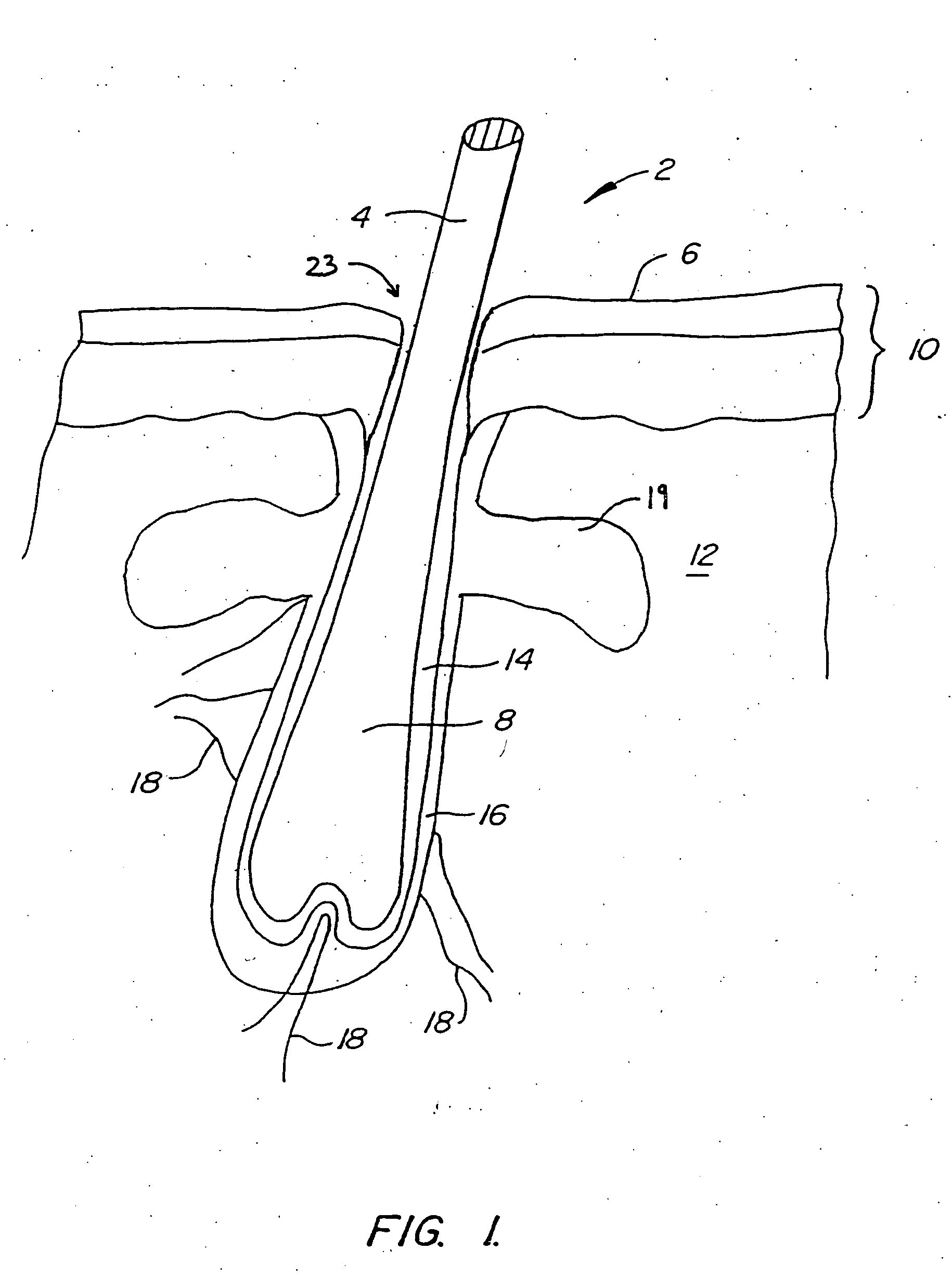 Methods and devices for non-ablative laser treatment of dermatologic conditions