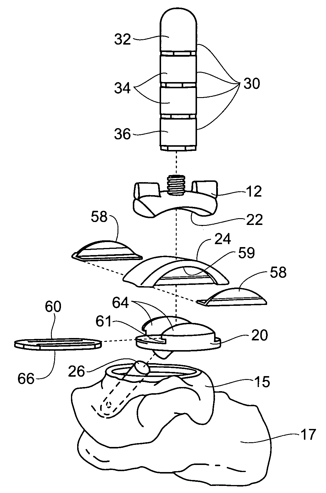 Ankle replacement system