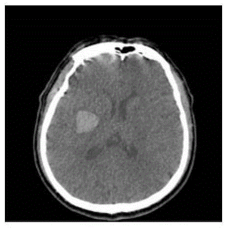 Intracranial hemorrhage area segmentation method based on three-dimensional super voxel and system thereof