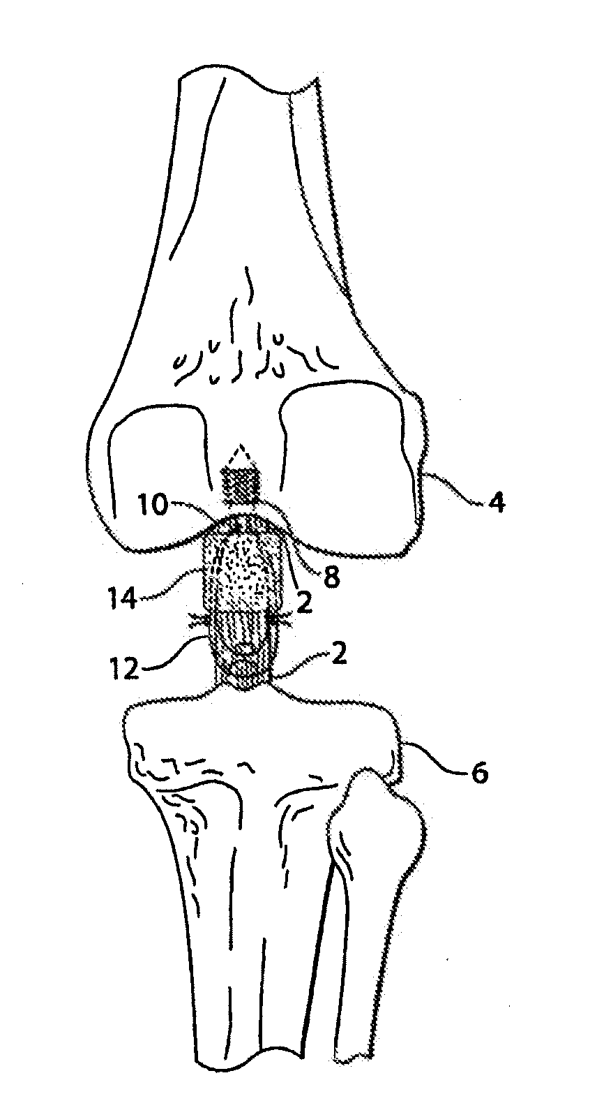 Methods and procedures for ligament repair