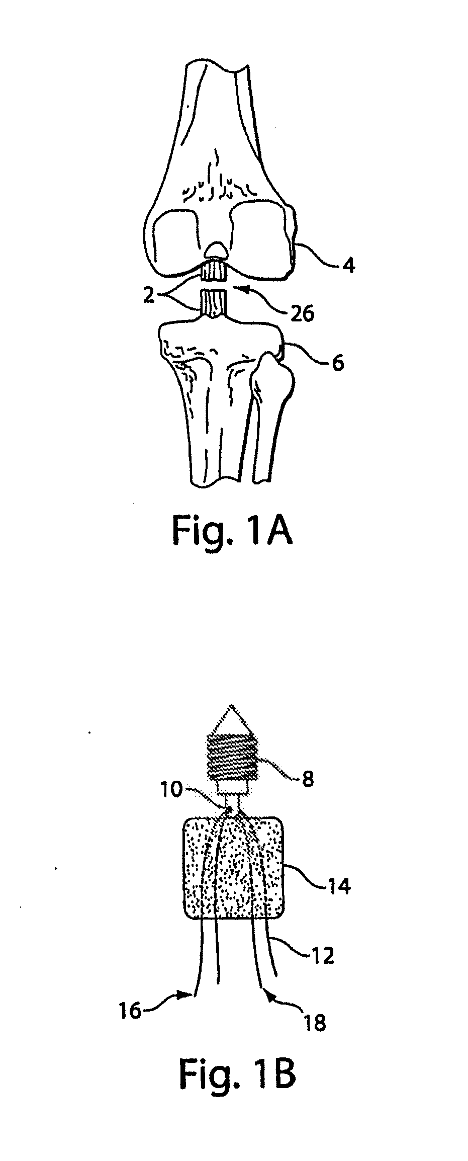 Methods and procedures for ligament repair