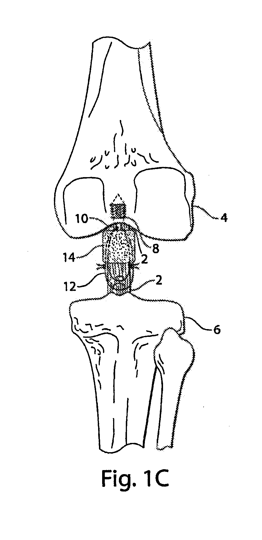 Methods and procedures for ligament repair