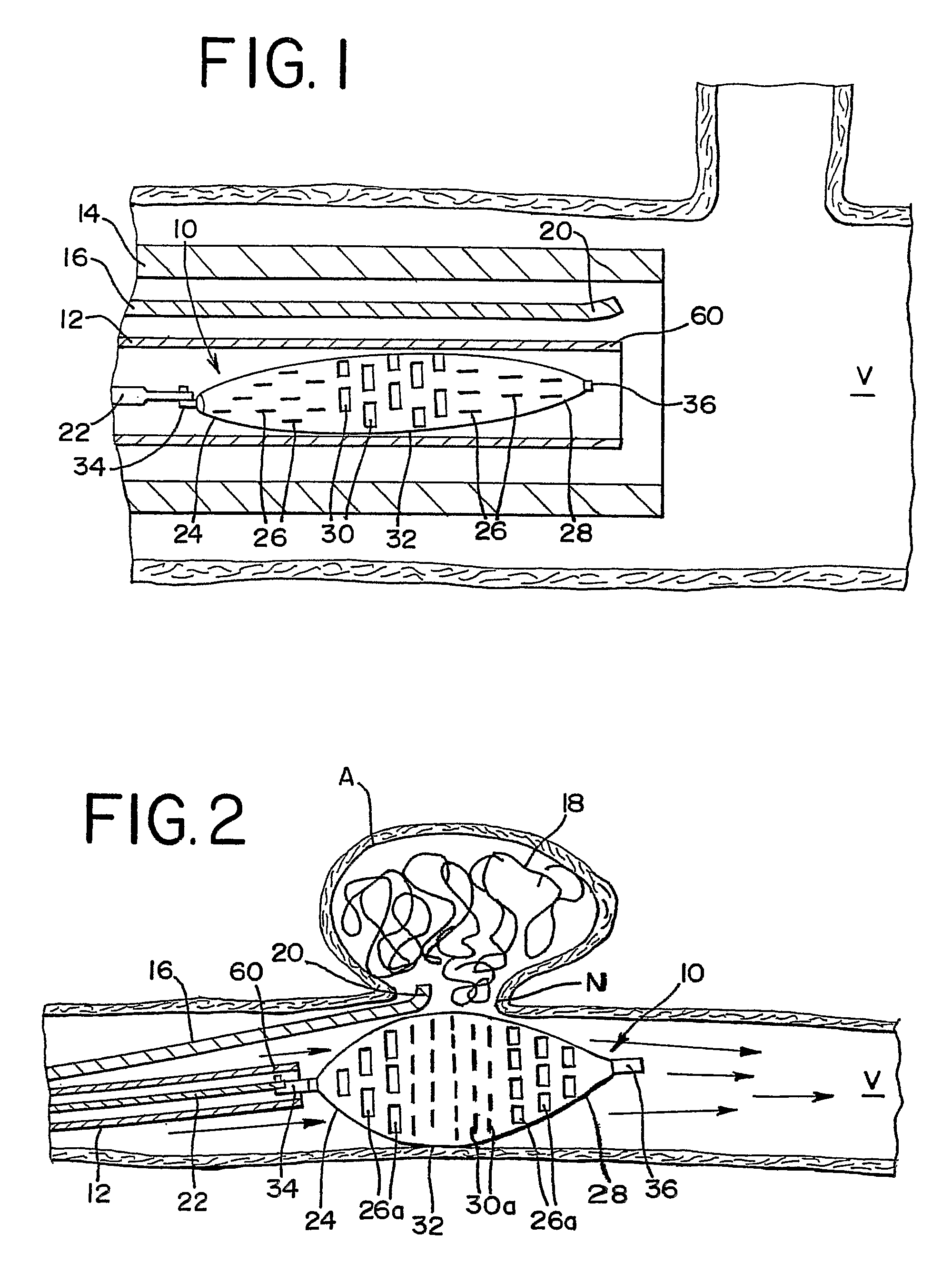 Remodeling device for aneurysms