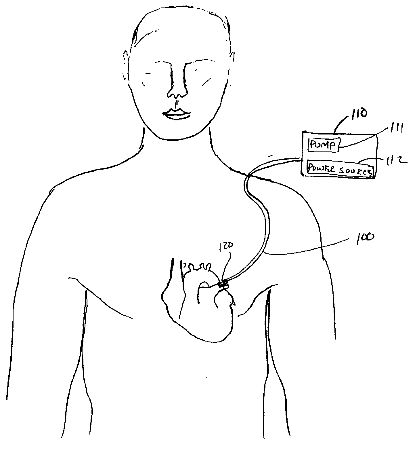 Neurotoxic agents and devices to treat atrial fibrillation