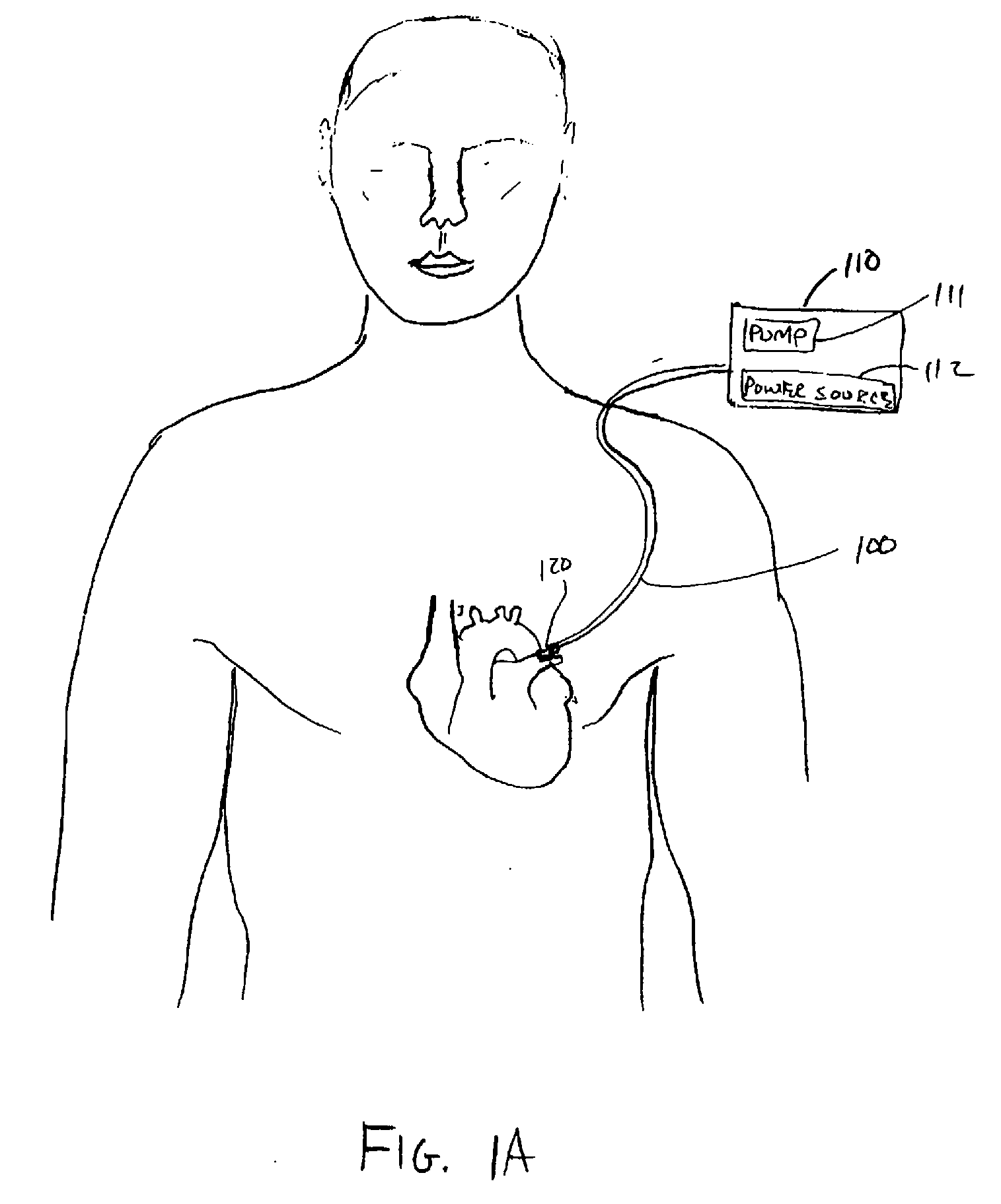 Neurotoxic agents and devices to treat atrial fibrillation