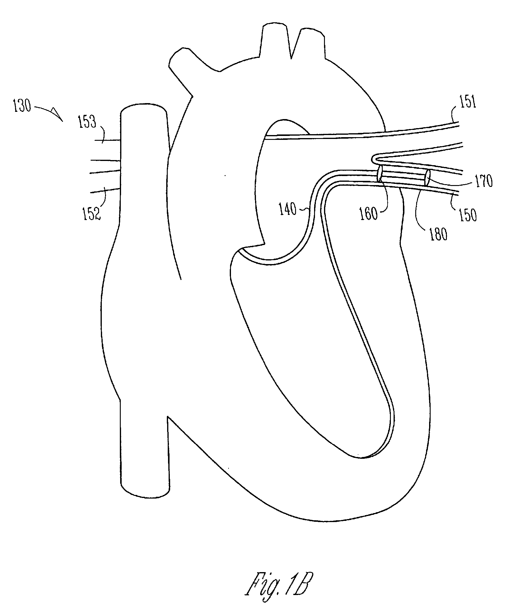 Neurotoxic agents and devices to treat atrial fibrillation