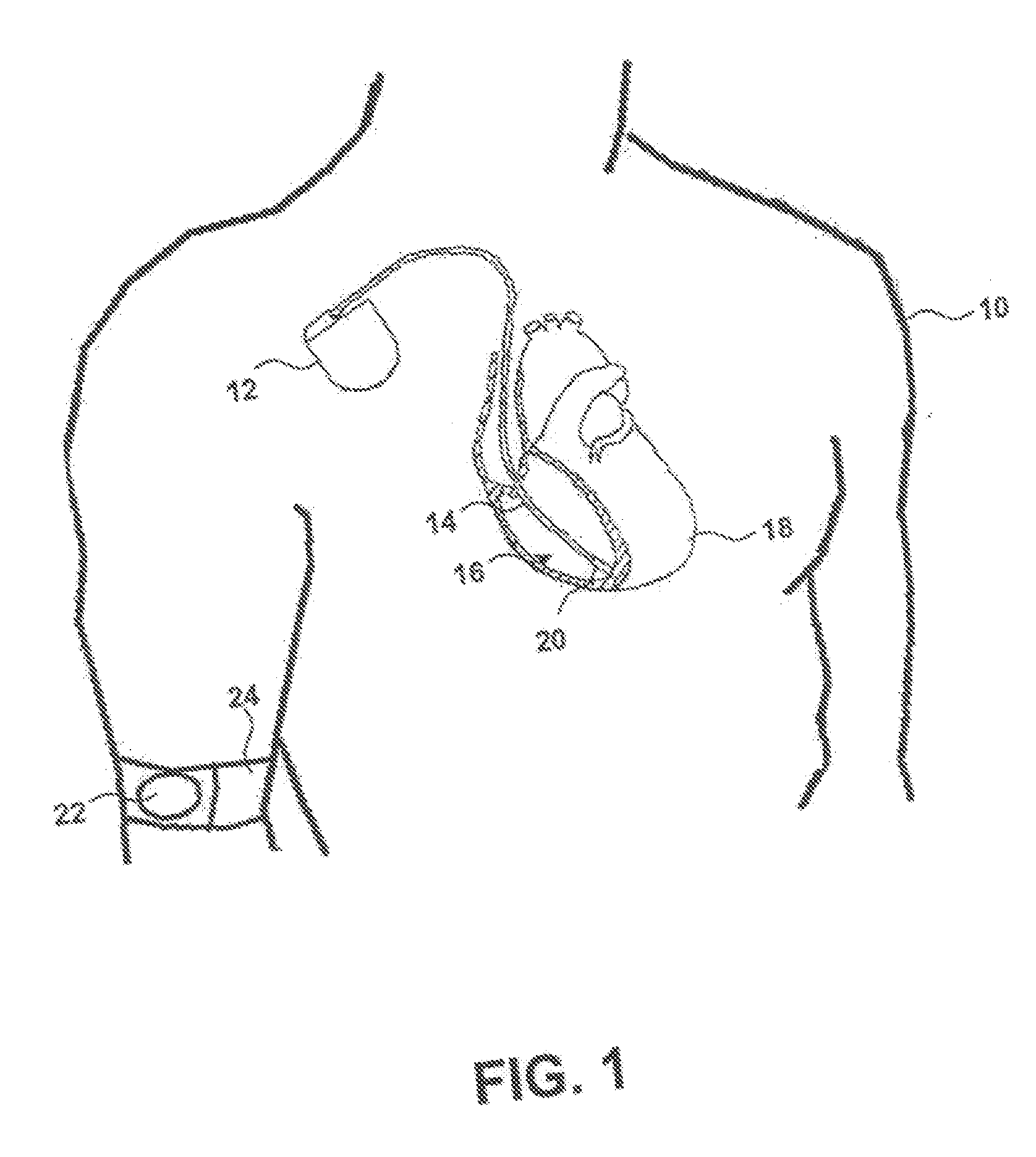 Fault tolerant implantable sensors having redundant electrical grounding connections