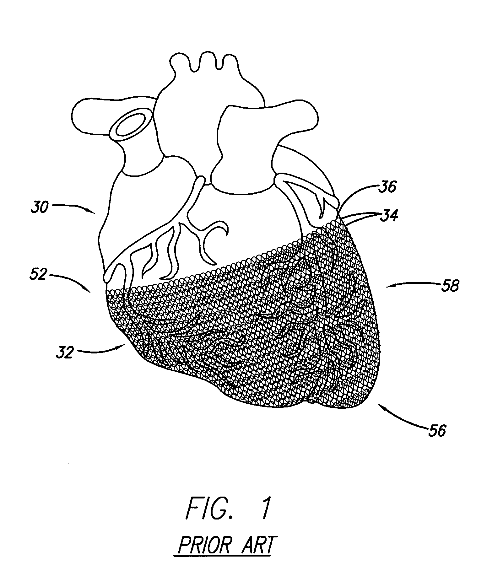 Self-anchoring cardiac harness