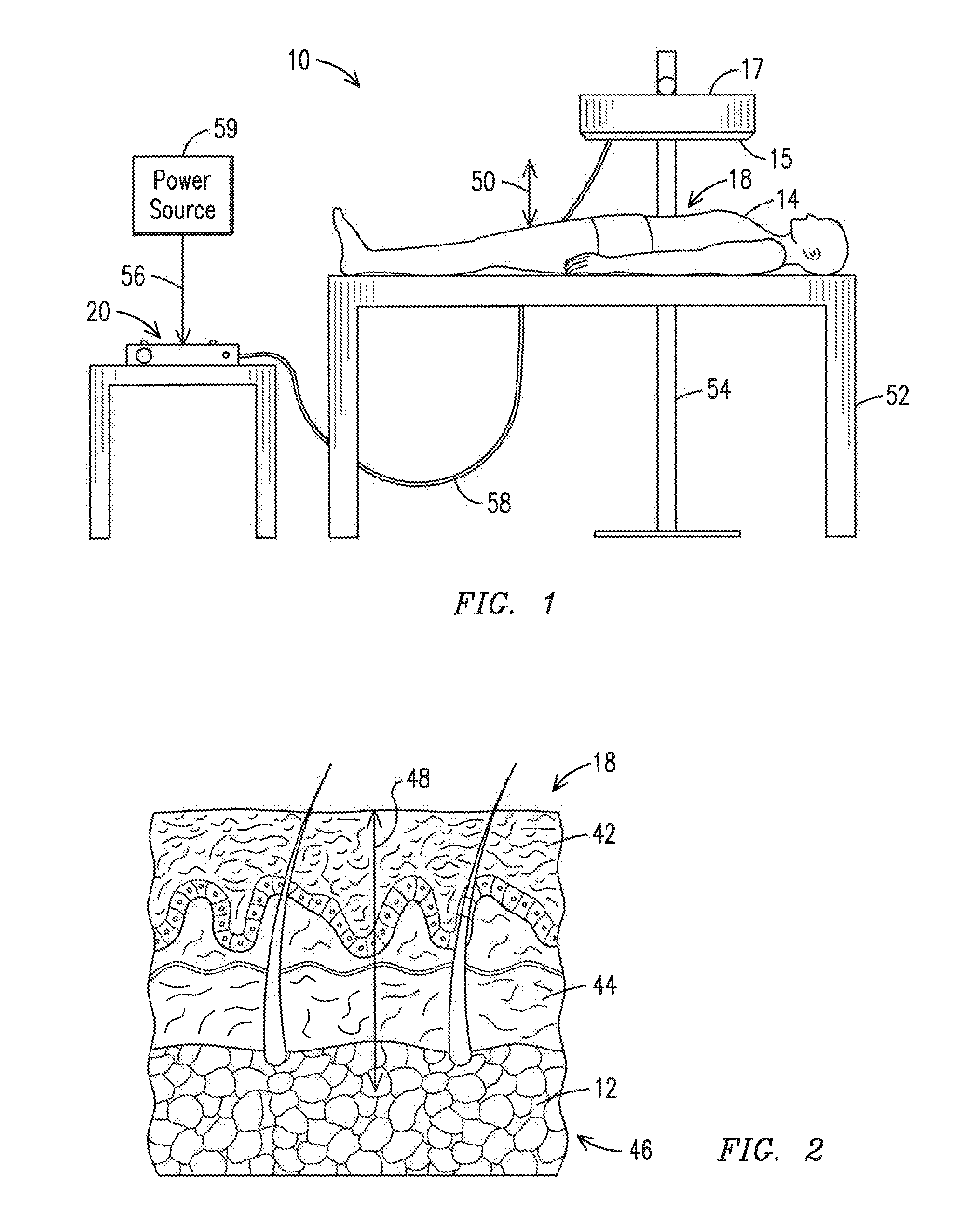 System and method for reducing lipid content of adipocytes in a body