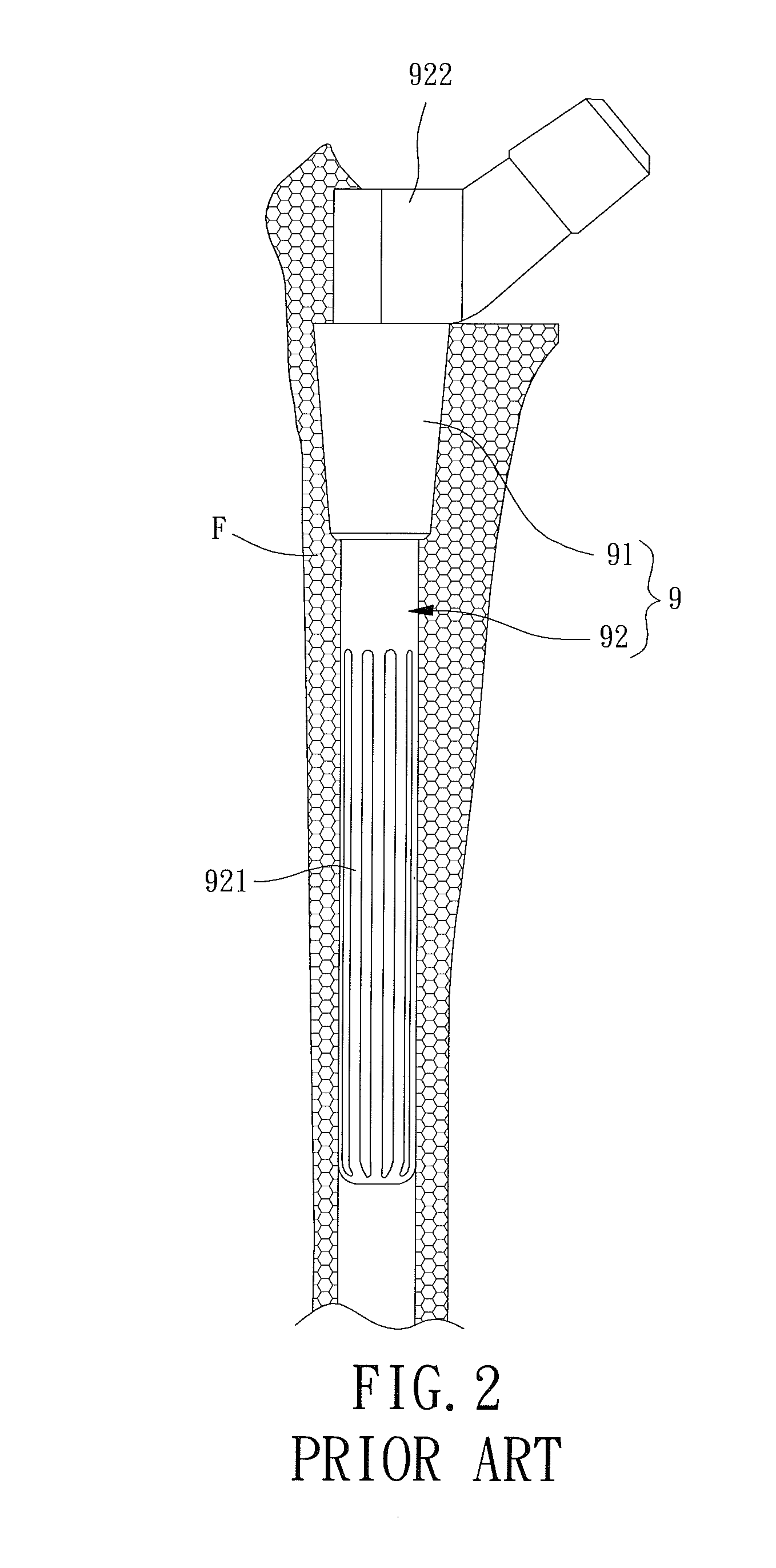 Femur Supporting Device