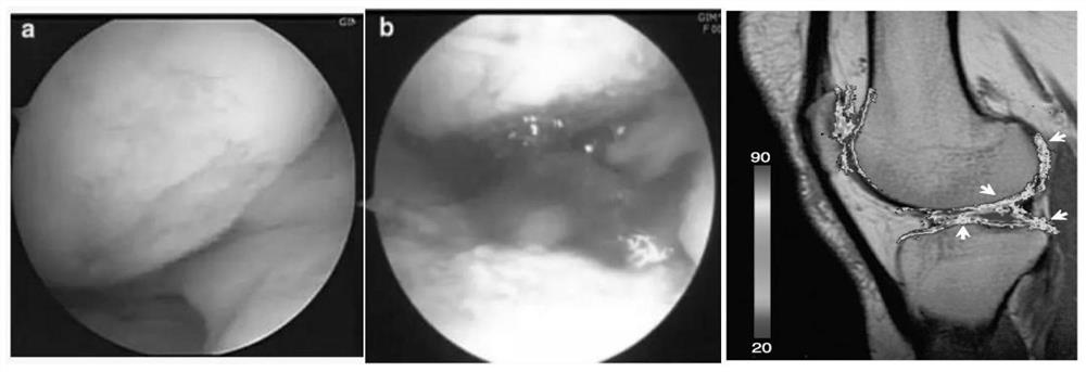 Application of mesenchymal stem cells combined with PRP (platelet-rich plasma) in preparation of medicine for treating knee joint cartilage injury and osteoarthritis