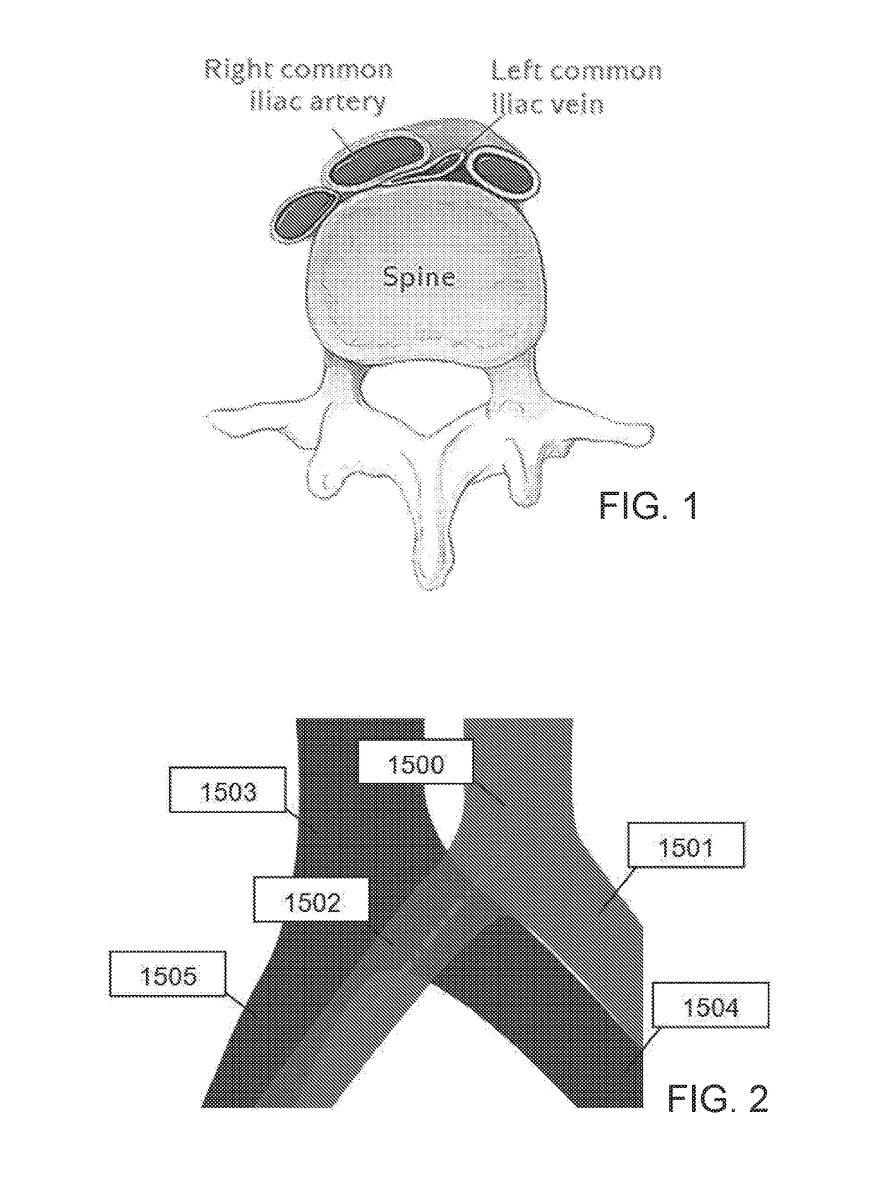 Intravascular implants