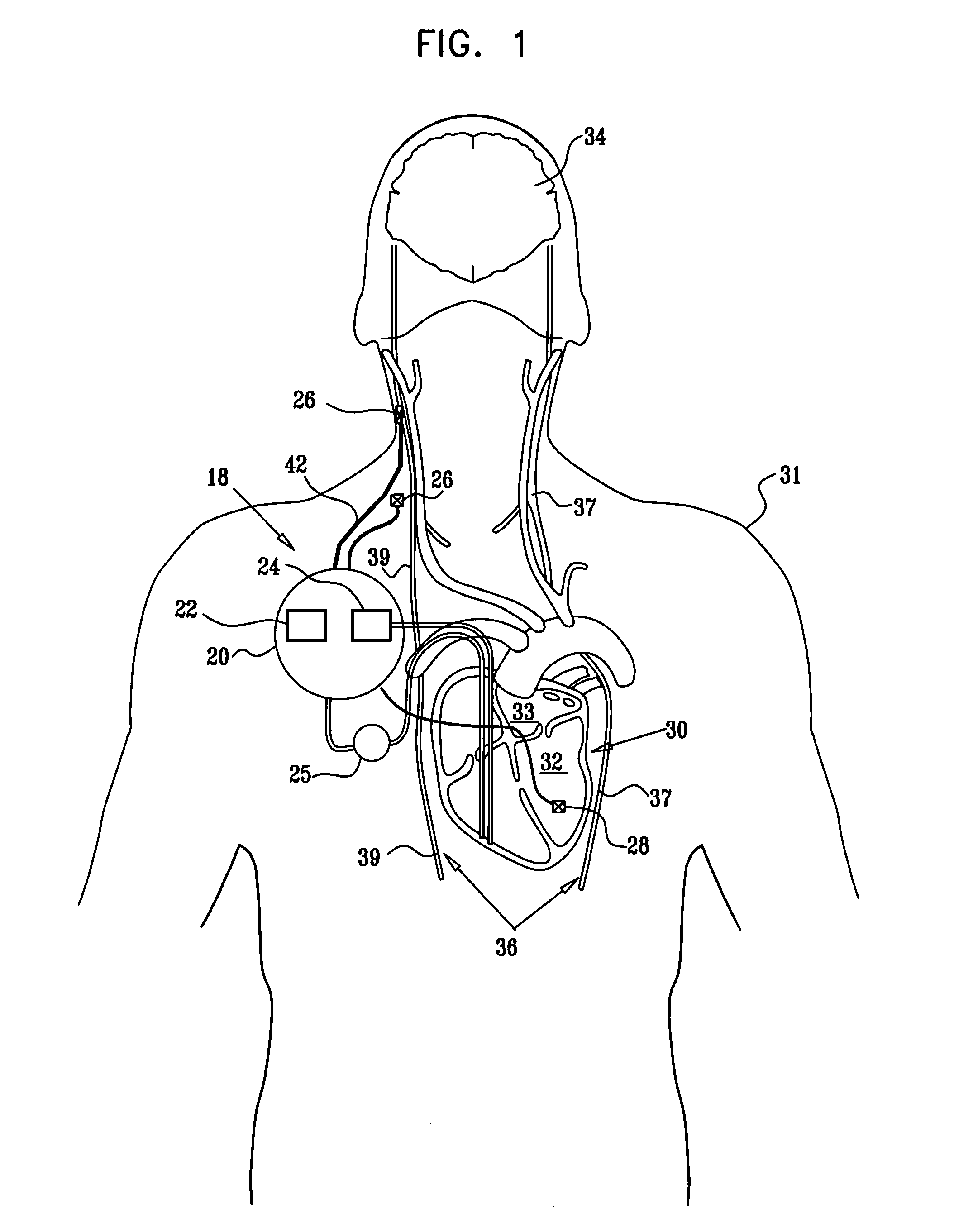 Intermittent electrical stimulation