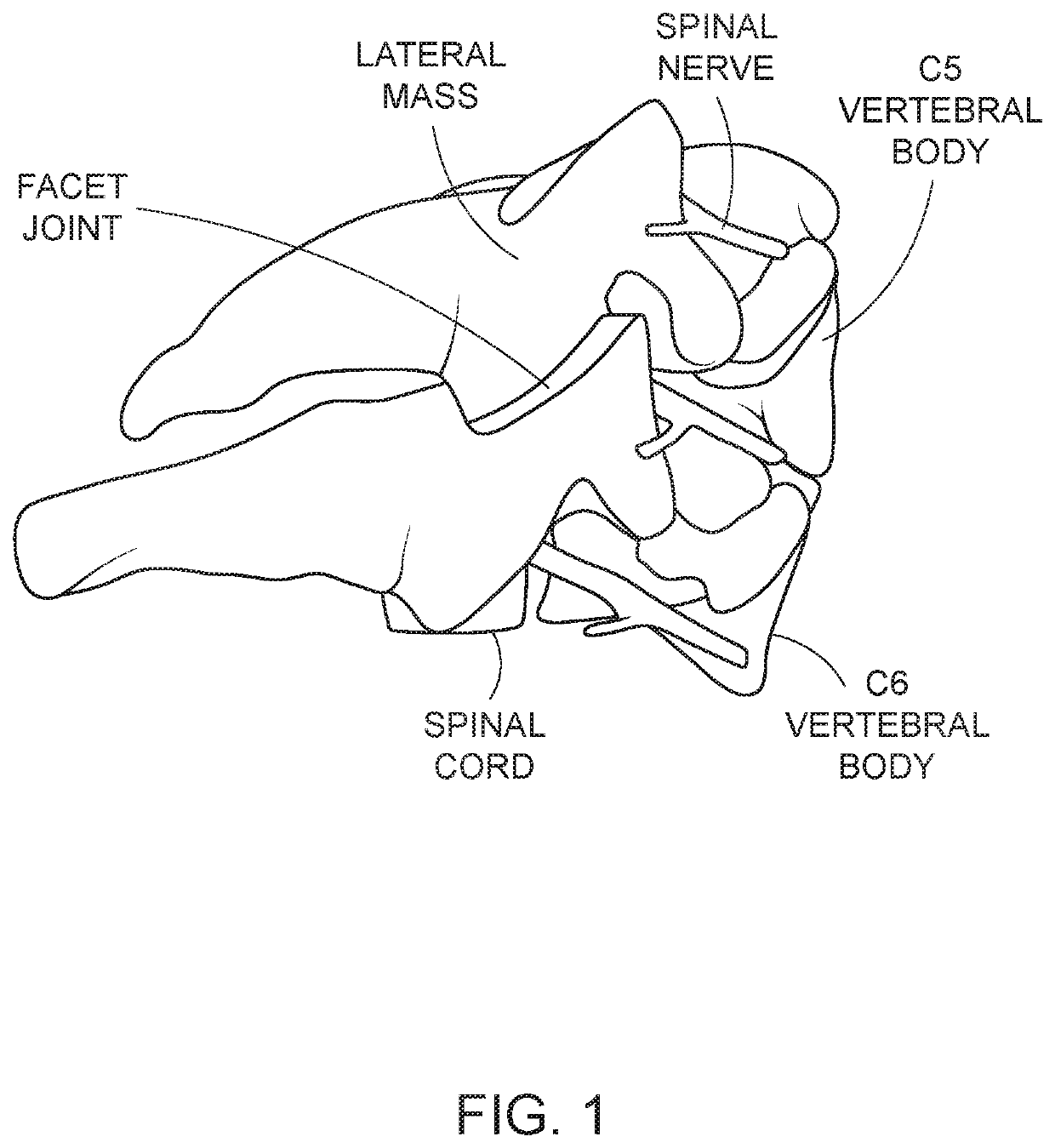 Spinal fixation access and delivery system