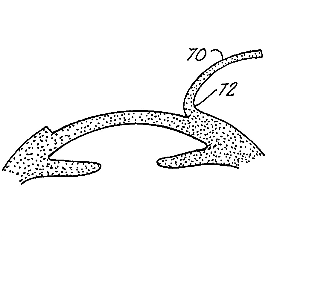 Corneal implant and method of manufacture