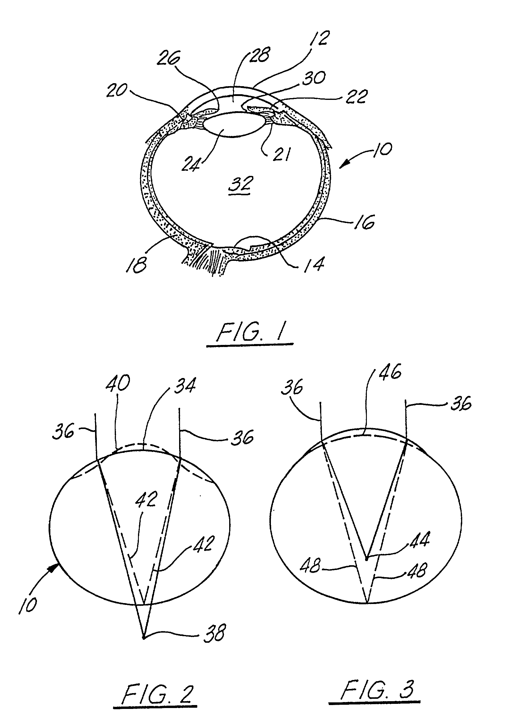 Corneal implant and method of manufacture