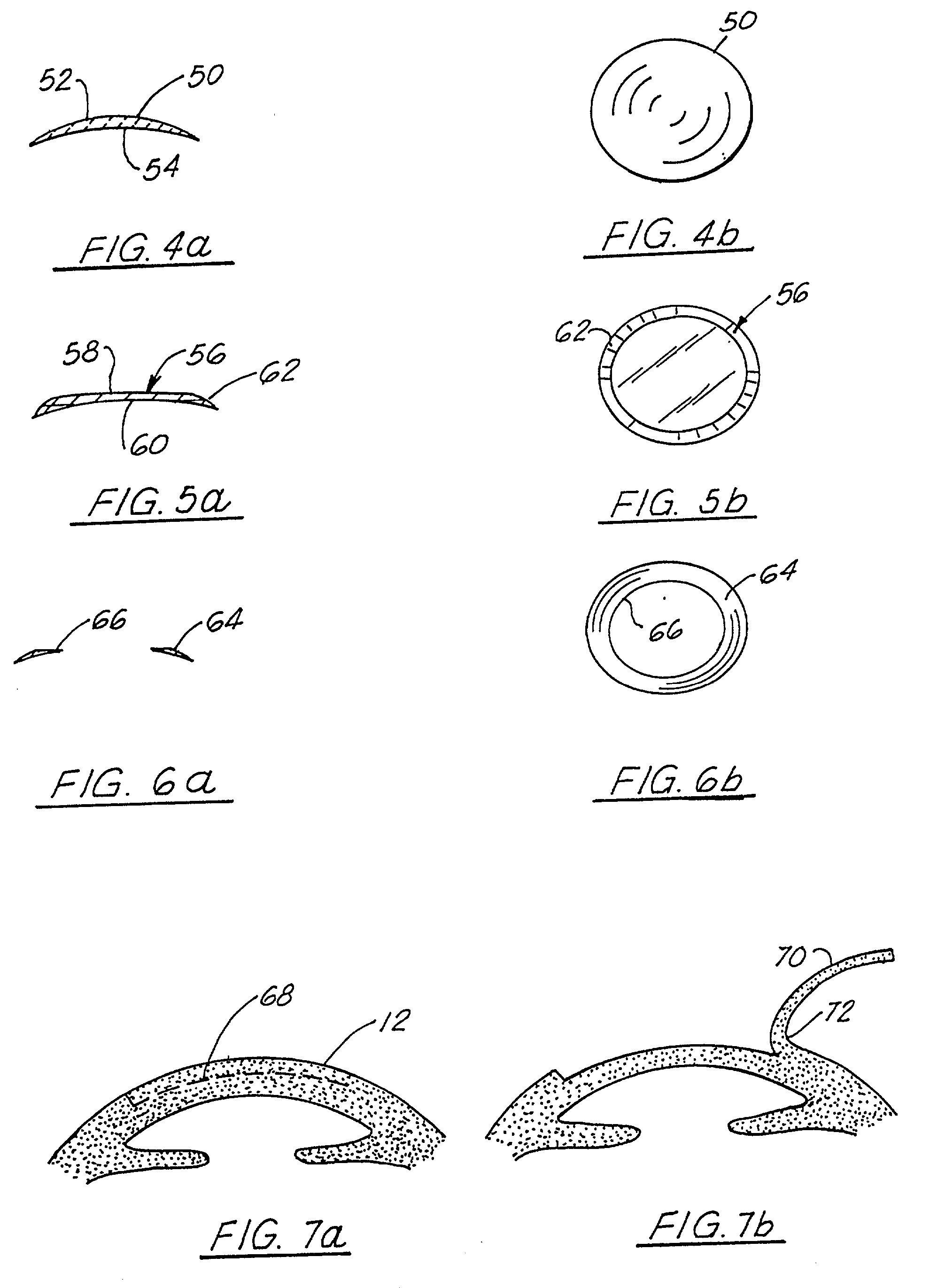 Corneal implant and method of manufacture