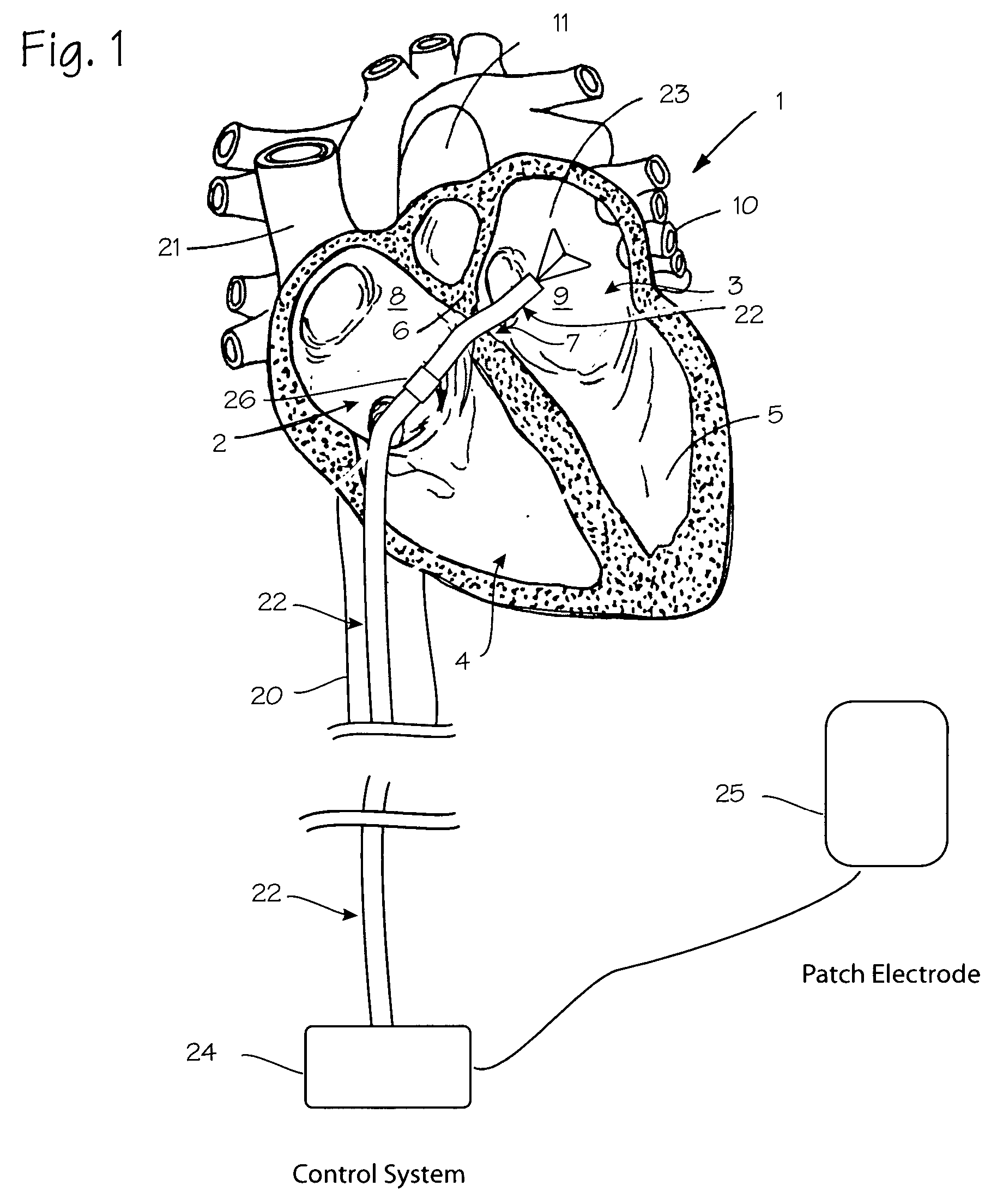 Atrial ablation catheter and method of use