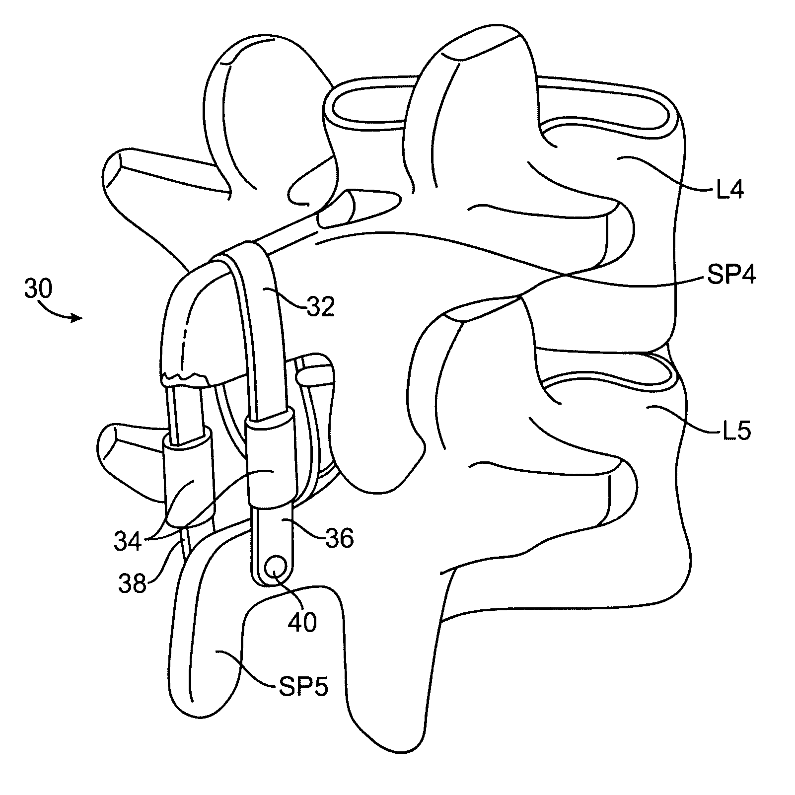 Methods and systems for constraint of spinous processes with attachment