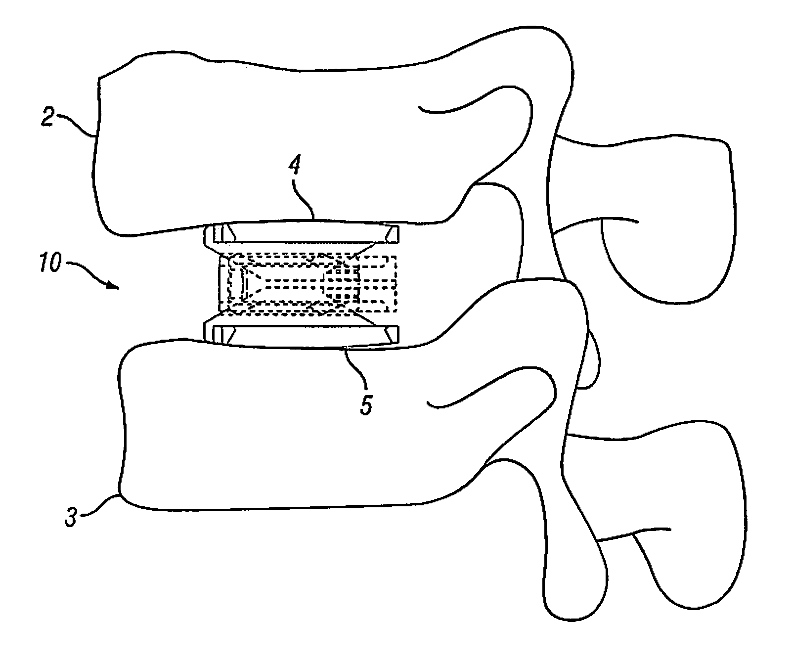 Expandable Fusion Device and Method of Installation Thereof