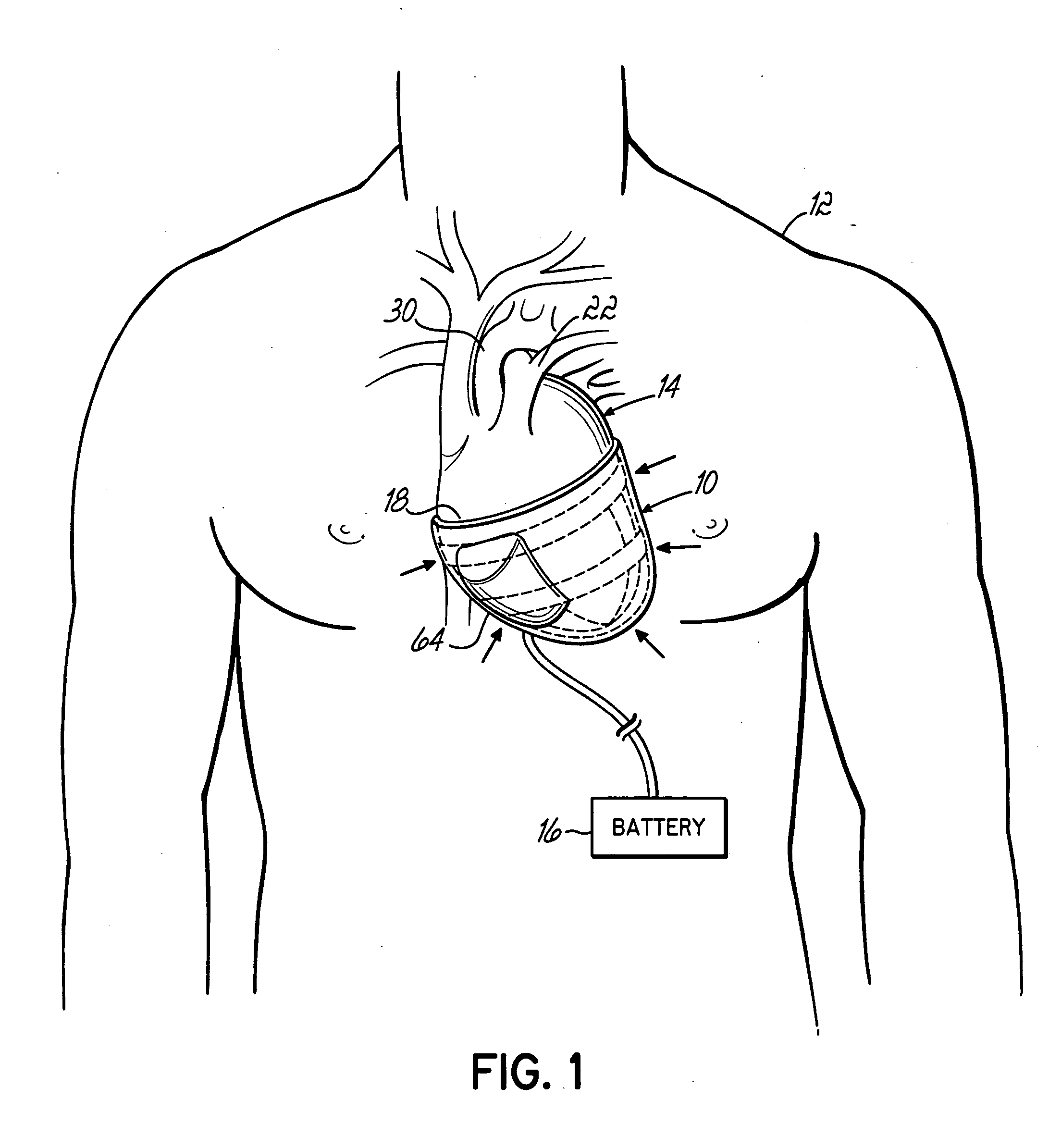 Implantable heart assist devices and methods