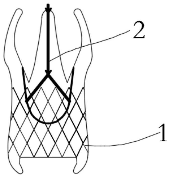 Valve prosthesis with variable positioning piece and conveying system thereof