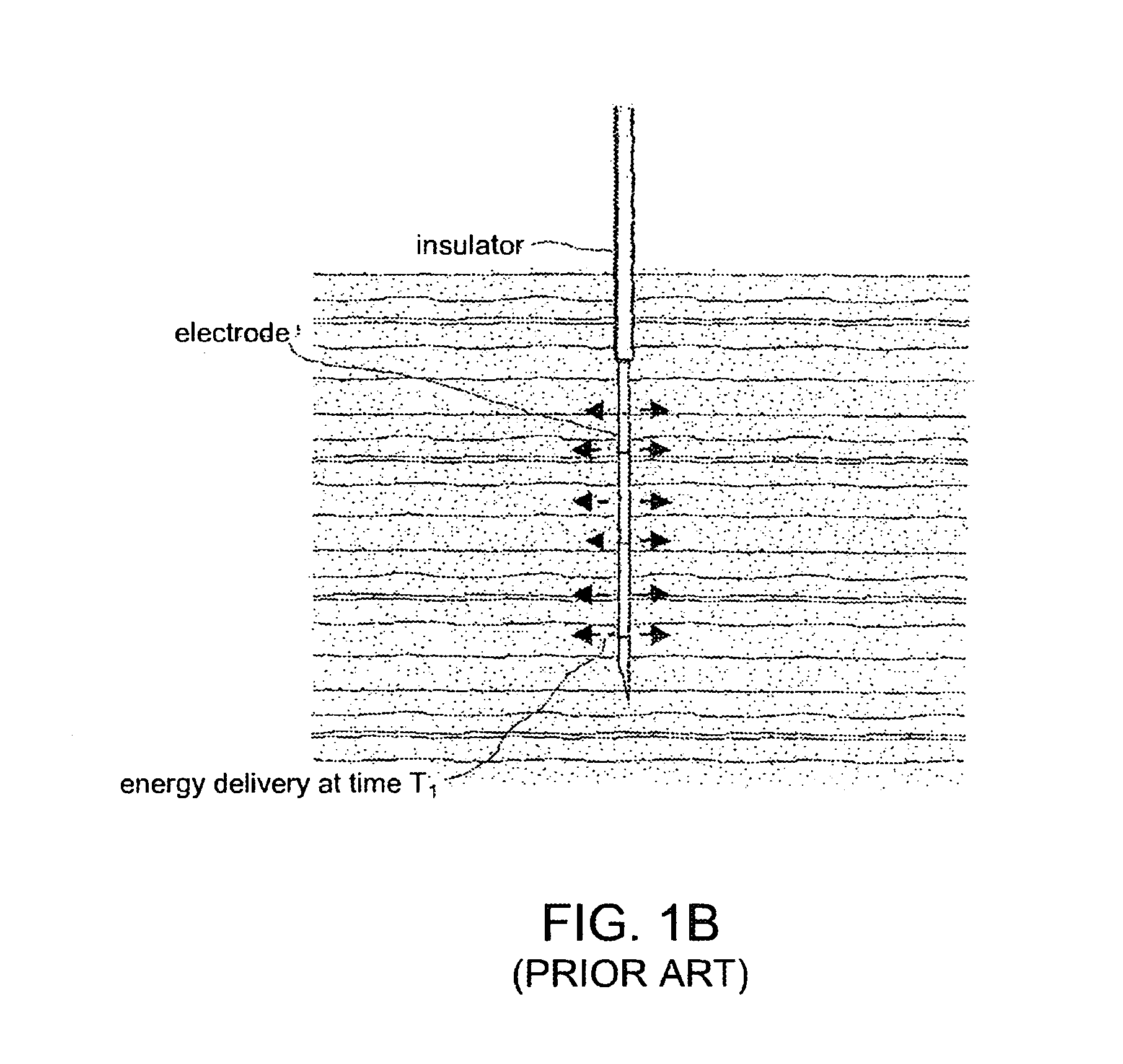 Electrosurgical working end for controlled energy delivery