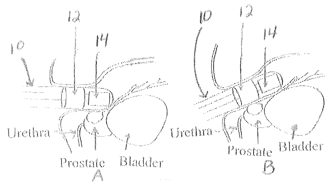 Endorectal prostate probe composed of a combined mini gamma camera and ultrasound sensor