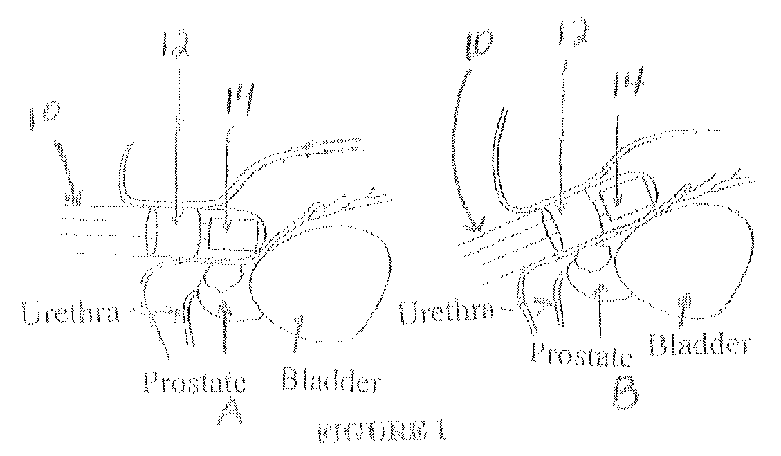 Endorectal prostate probe composed of a combined mini gamma camera and ultrasound sensor