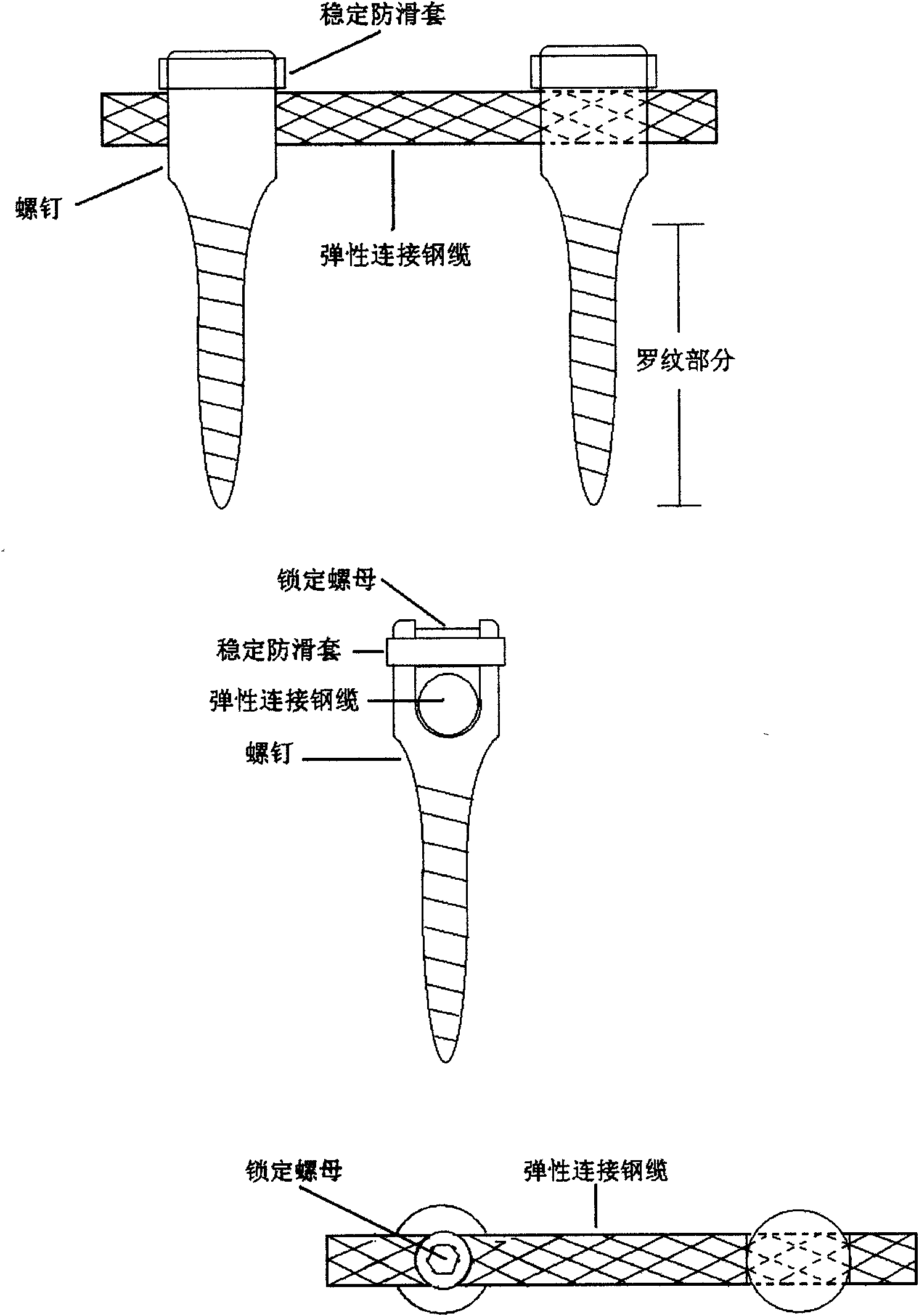 Dynamic stabilization system for vertebral column