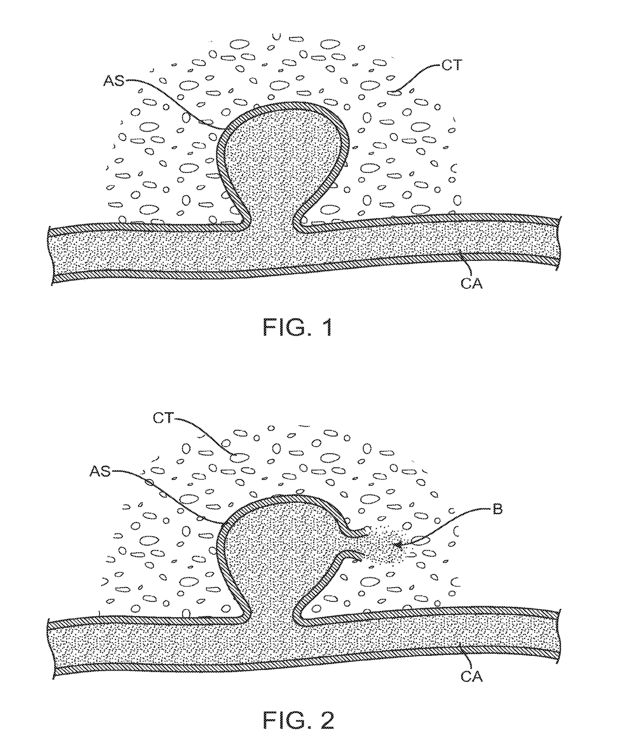 System and method for treatment of hemorrhagic stroke