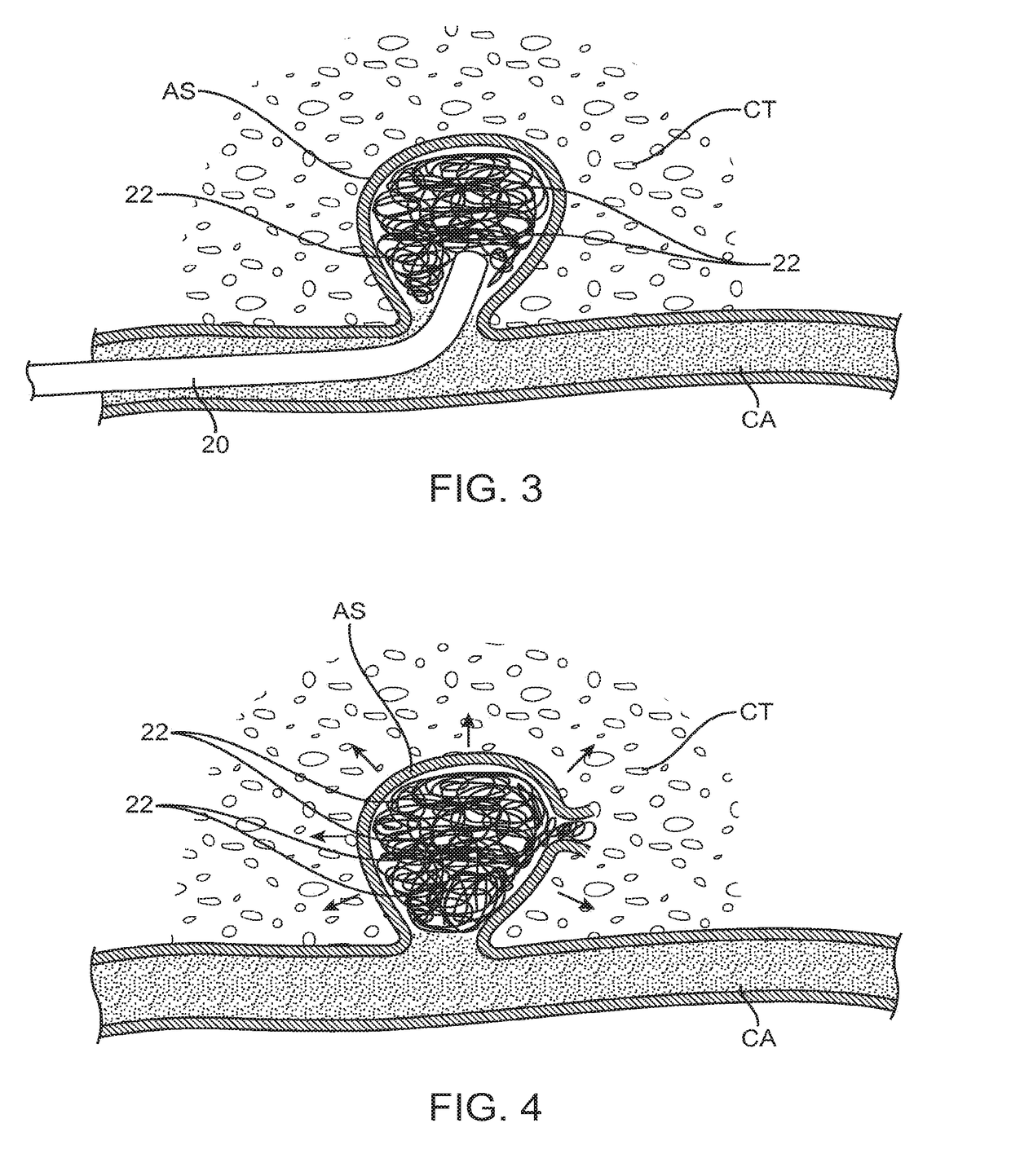 System and method for treatment of hemorrhagic stroke