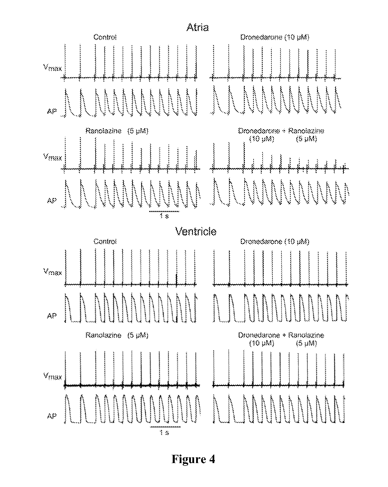 Method of treating atrial fibrillation