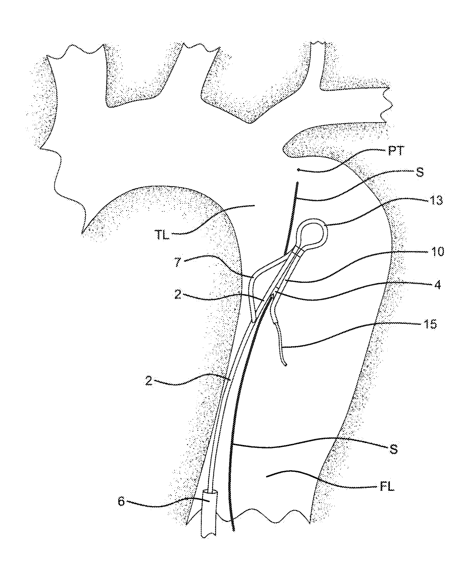 Method of using an aortic dissection septal cutting tool