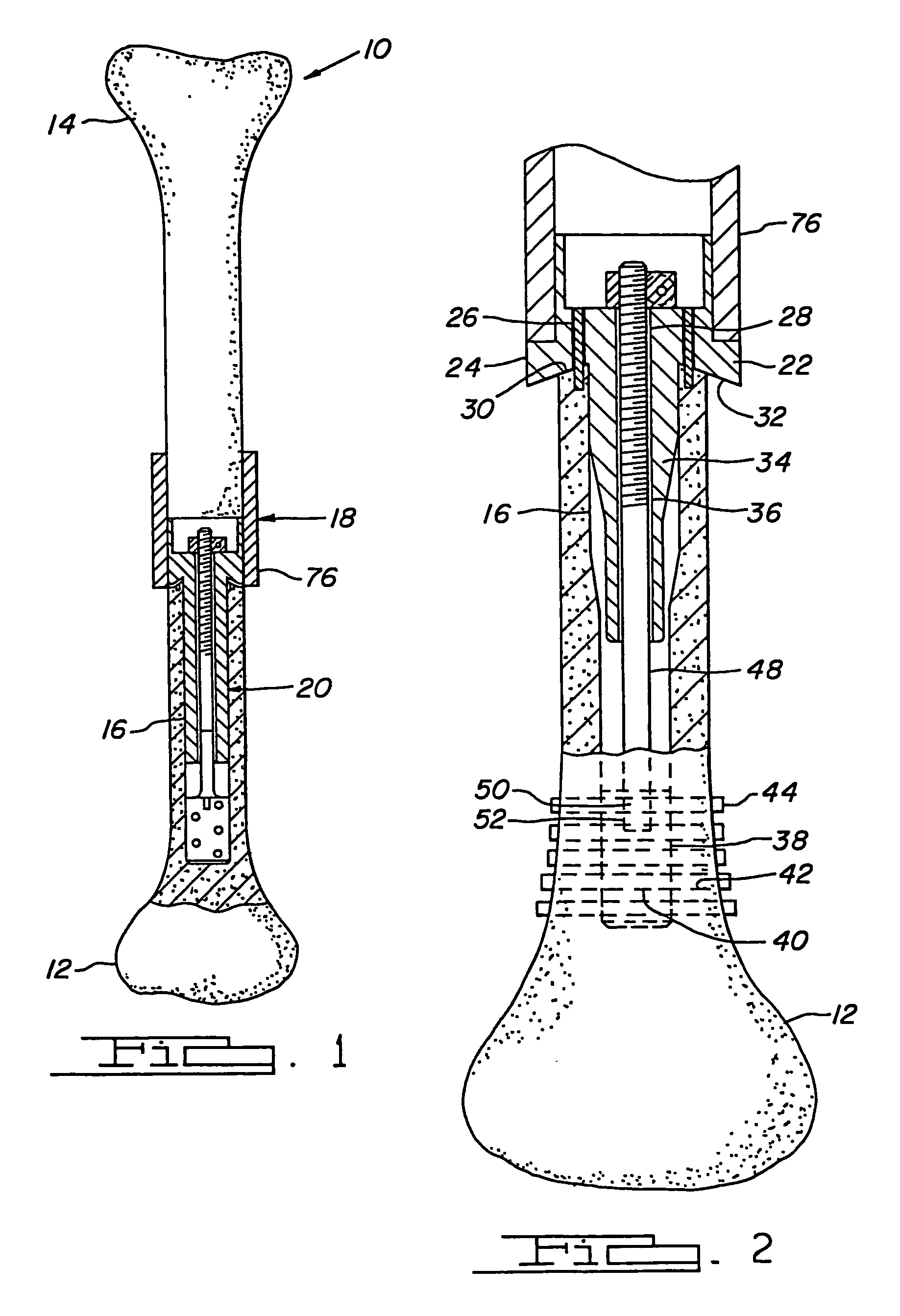 Compliant fixation of external prosthesis