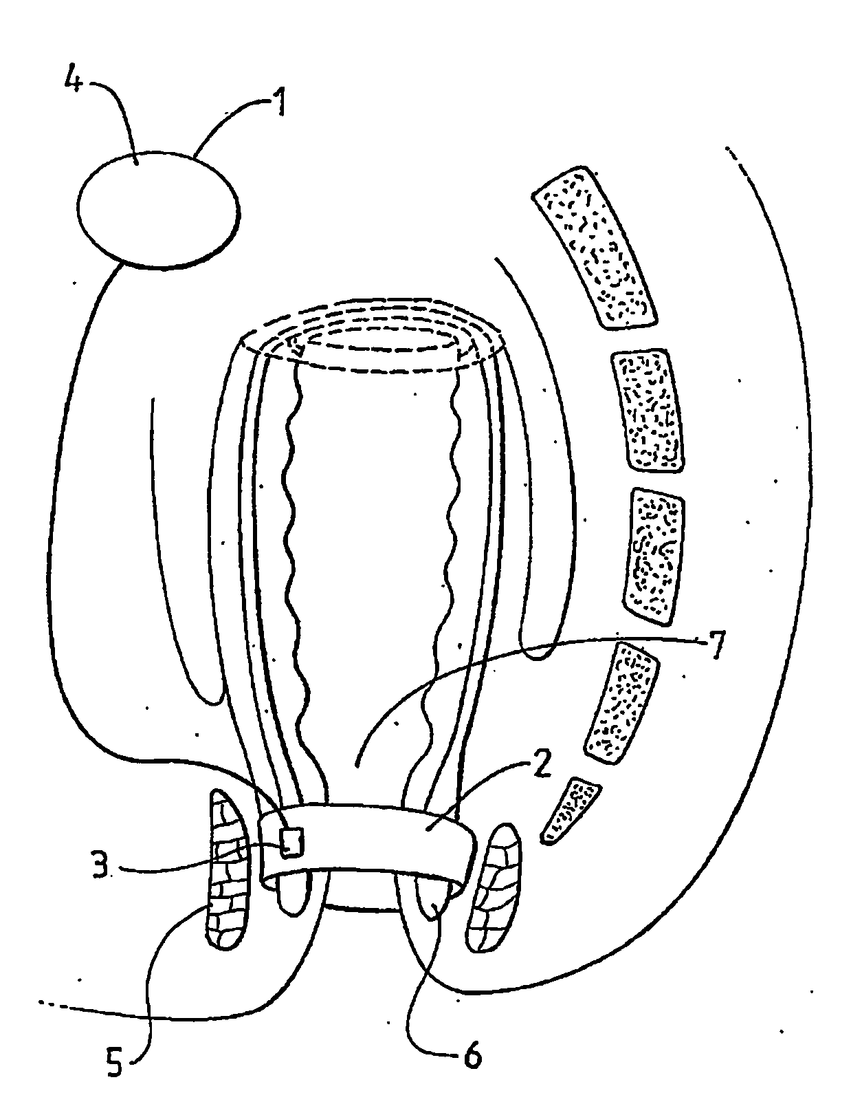 Method and Apparatus for Treating Fecal Incontinence