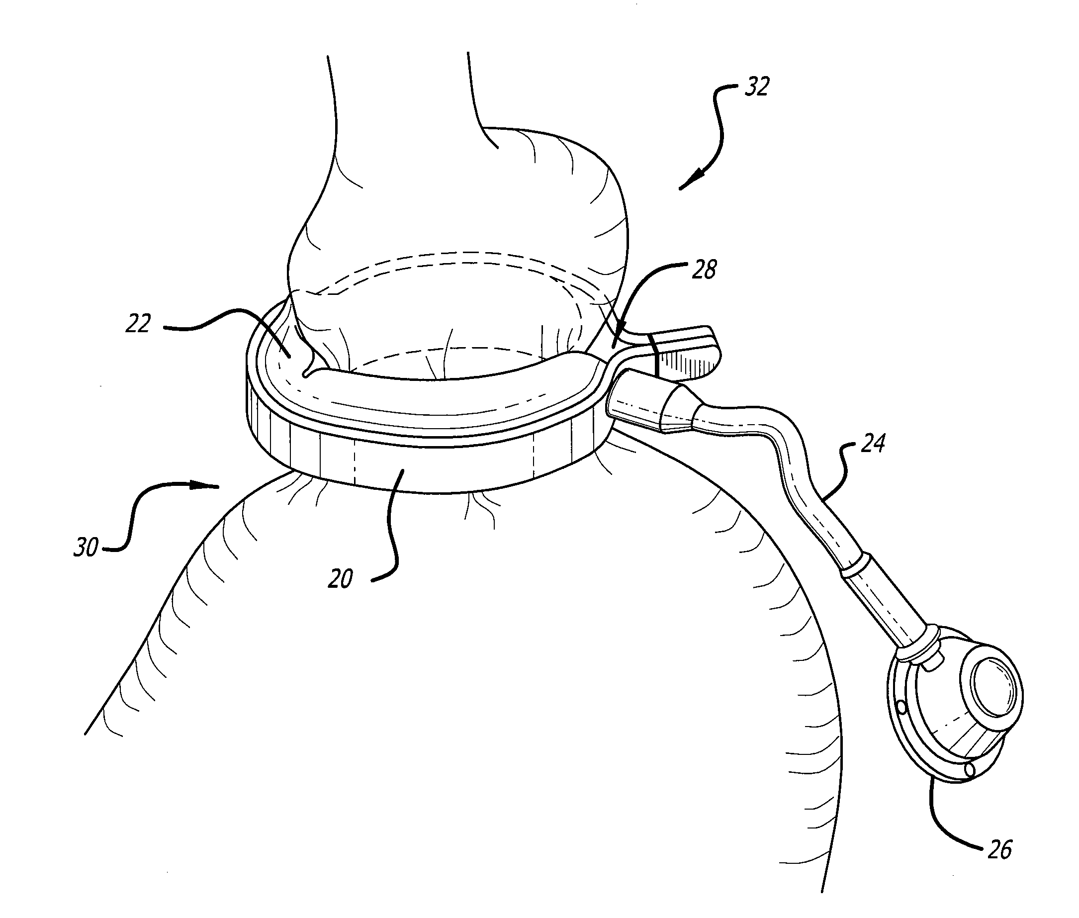 Assembly and method for automatically controlling pressure for a gastric band