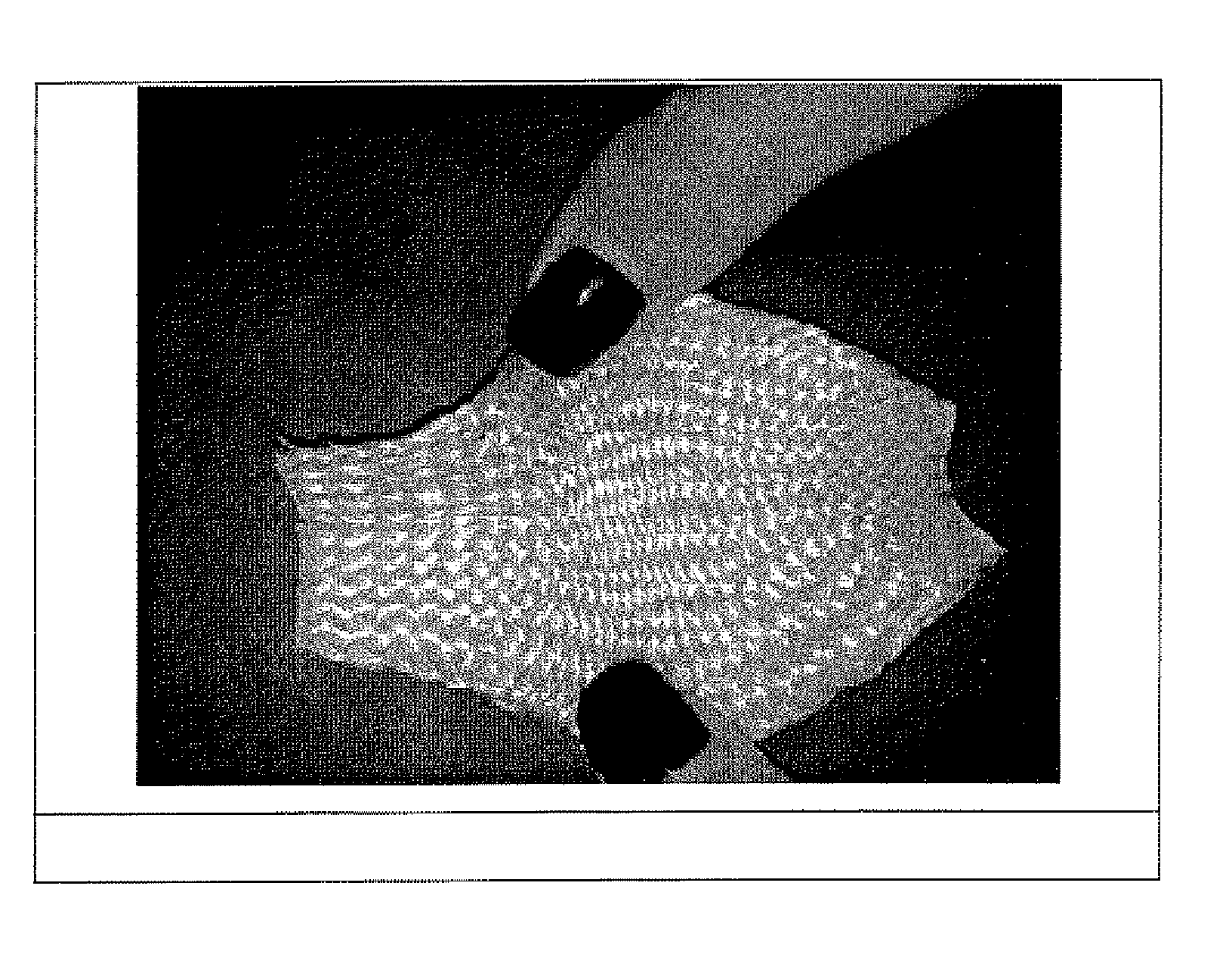 Absorbable Synthetic Braided Matrix for Breast Reconstruction and Hernia Repair