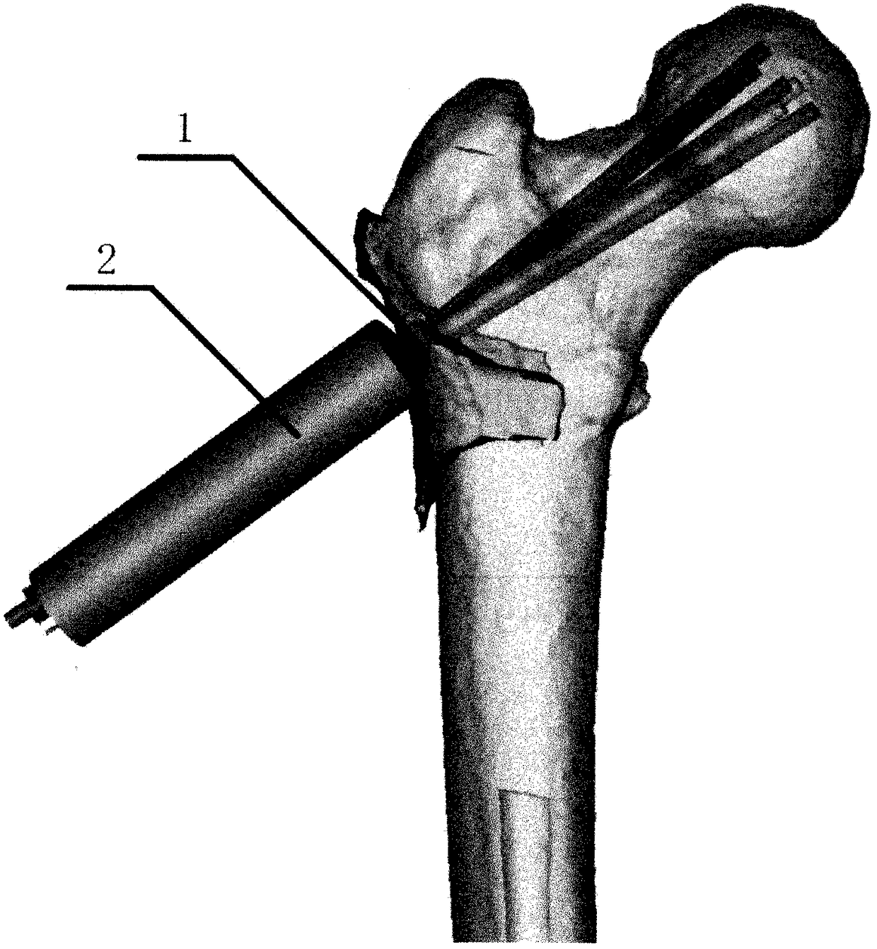 Preparation and testing method of a three-dimensional decompression device for avascular necrosis of the femoral head