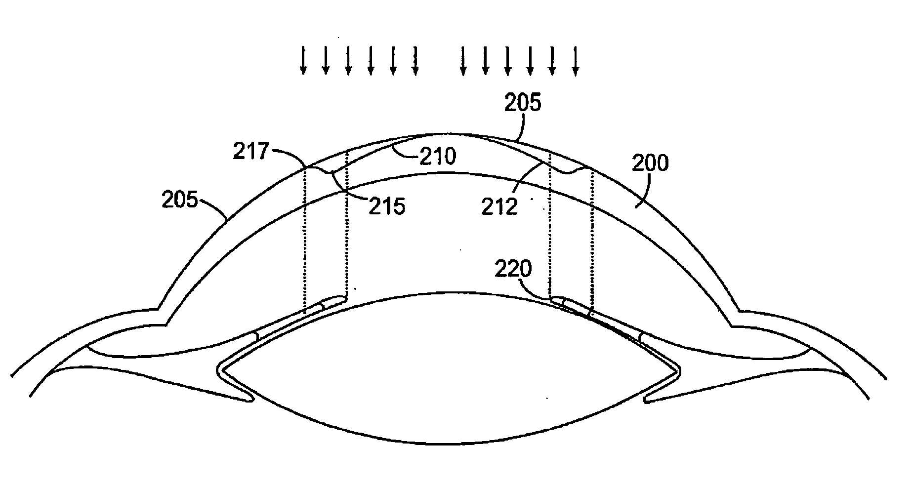 Binocular optical treatment for presbyopia