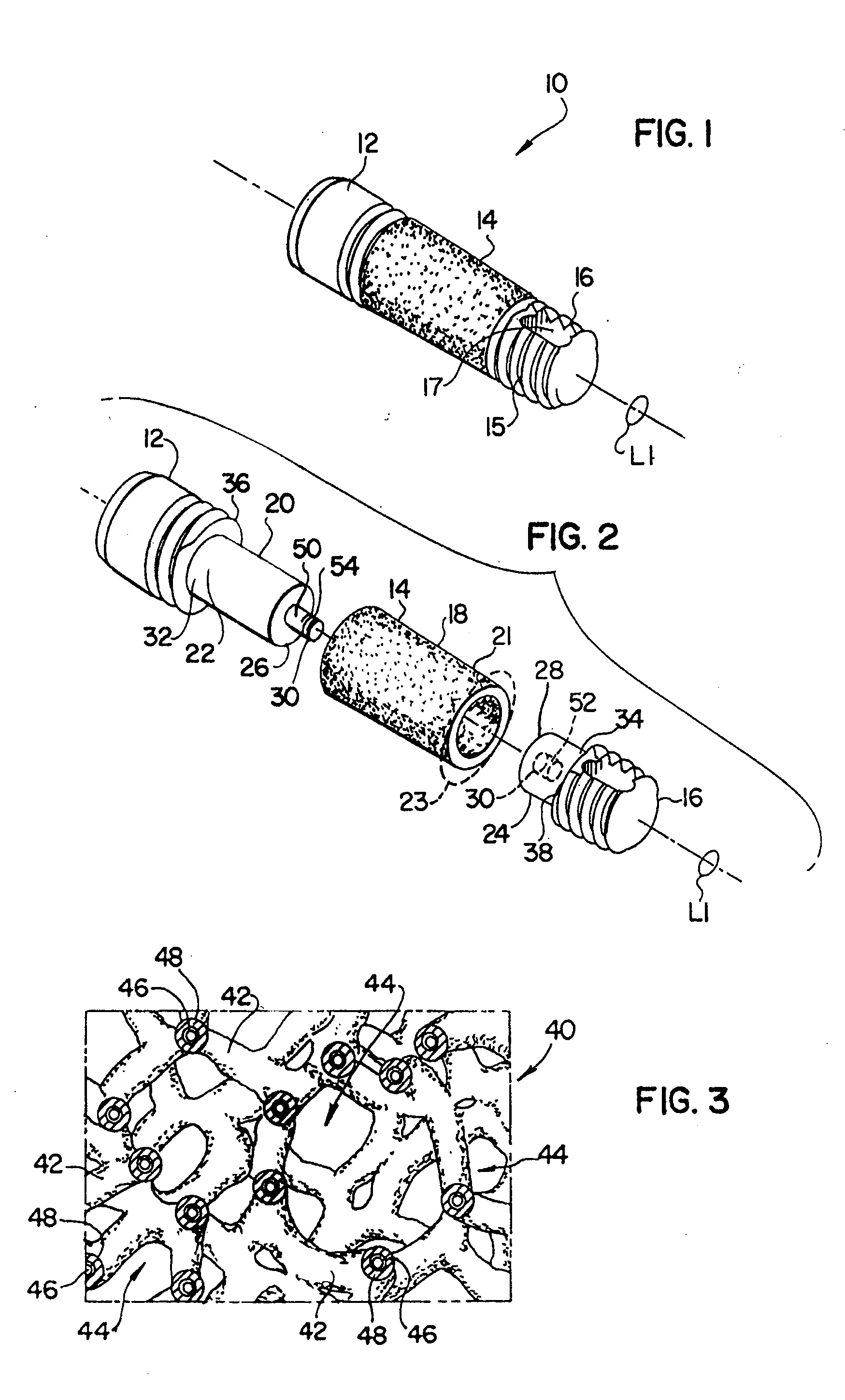 Modular implant with secured porous portion