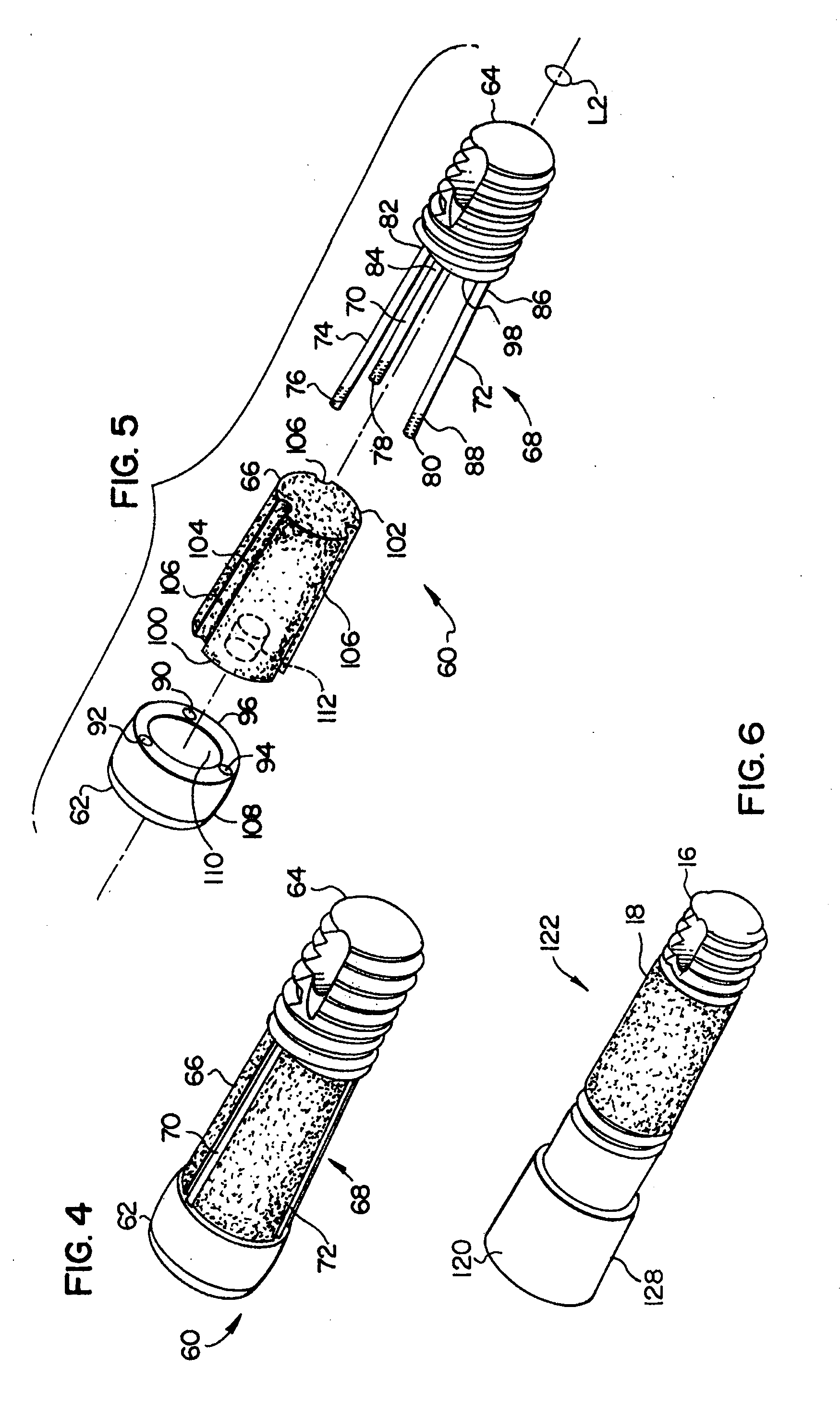 Modular implant with secured porous portion