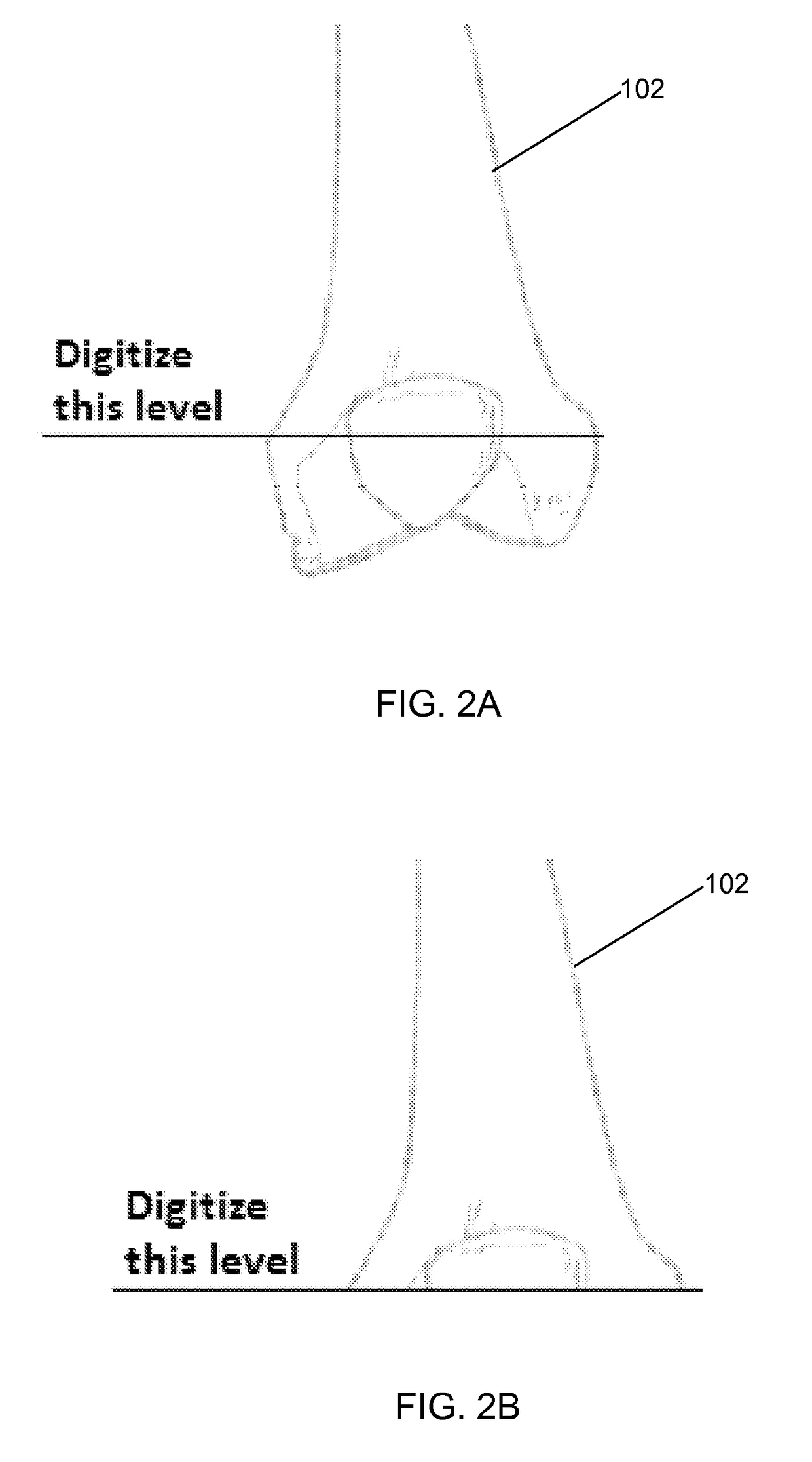 Implant based planning, digitizing, and registration for total joint arthroplasty