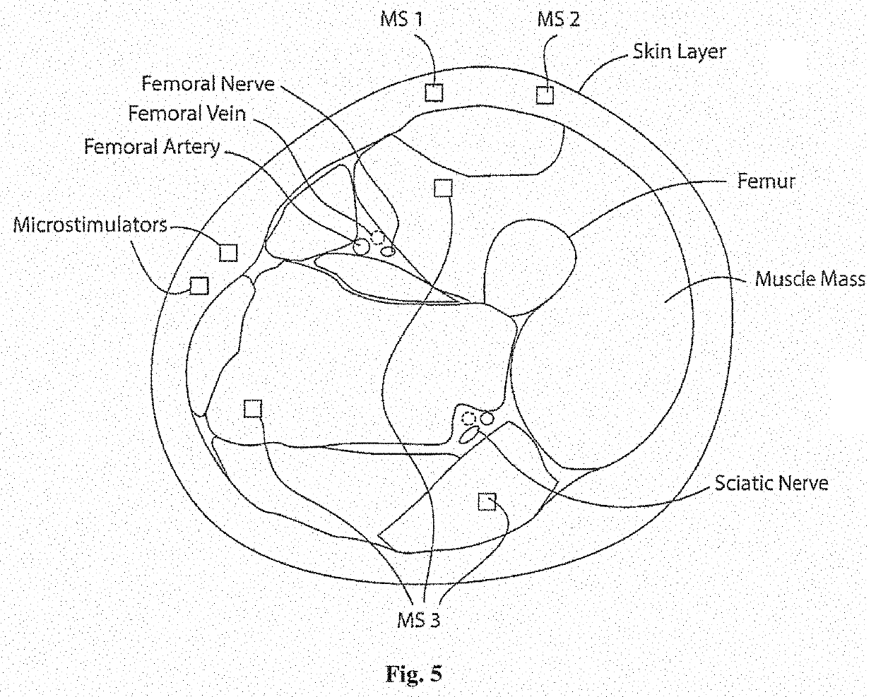 Apparatus for management of a parkinson's disease patient's gait