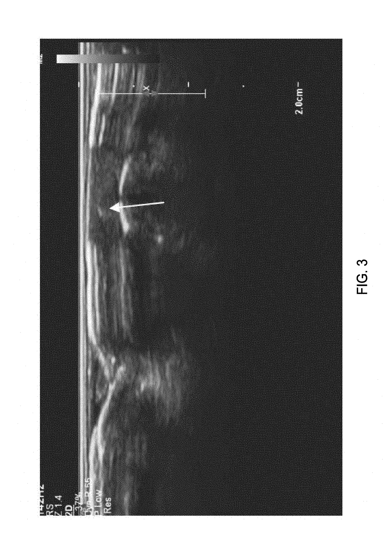 Methods for vas-occlusive contraception and reversal thereof